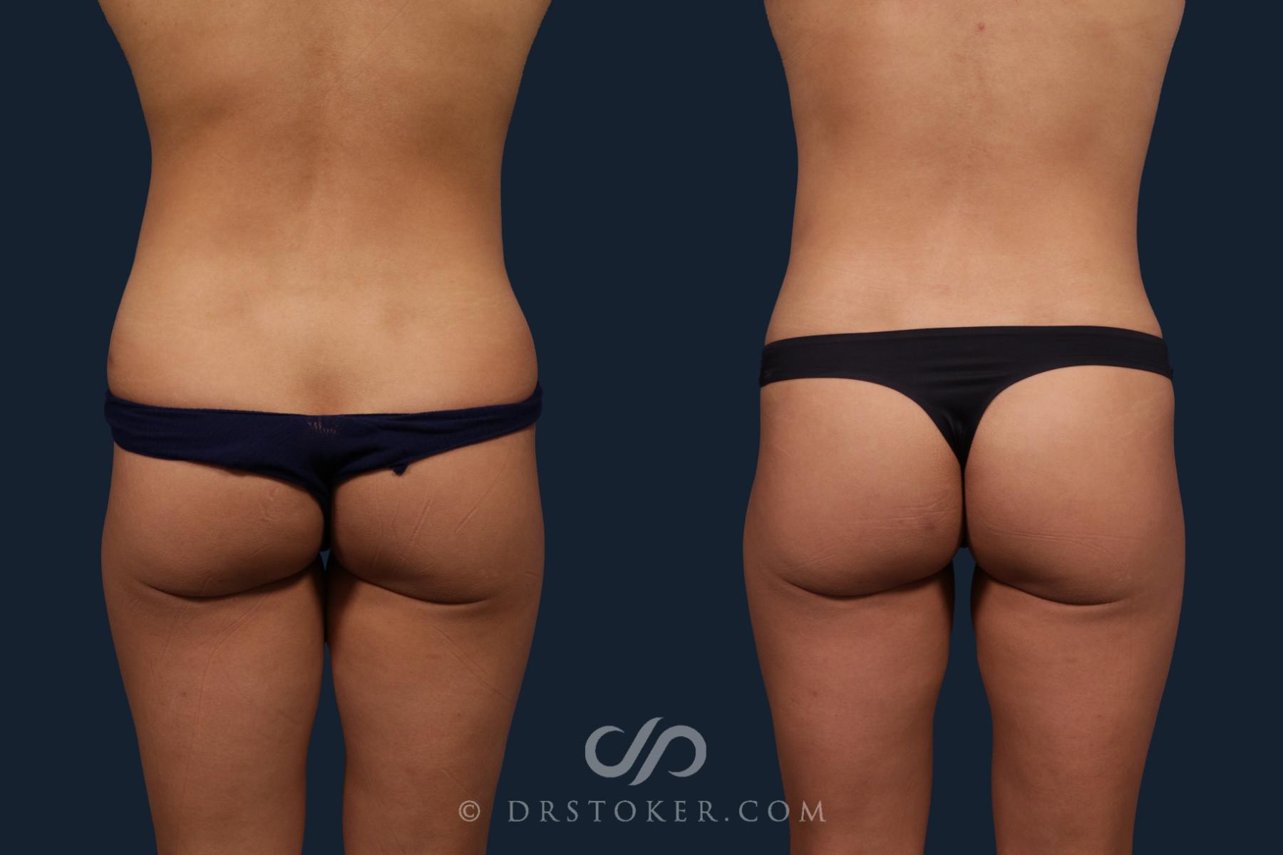 Before & After Liposuction Case 2182 Back View in Los Angeles, CA