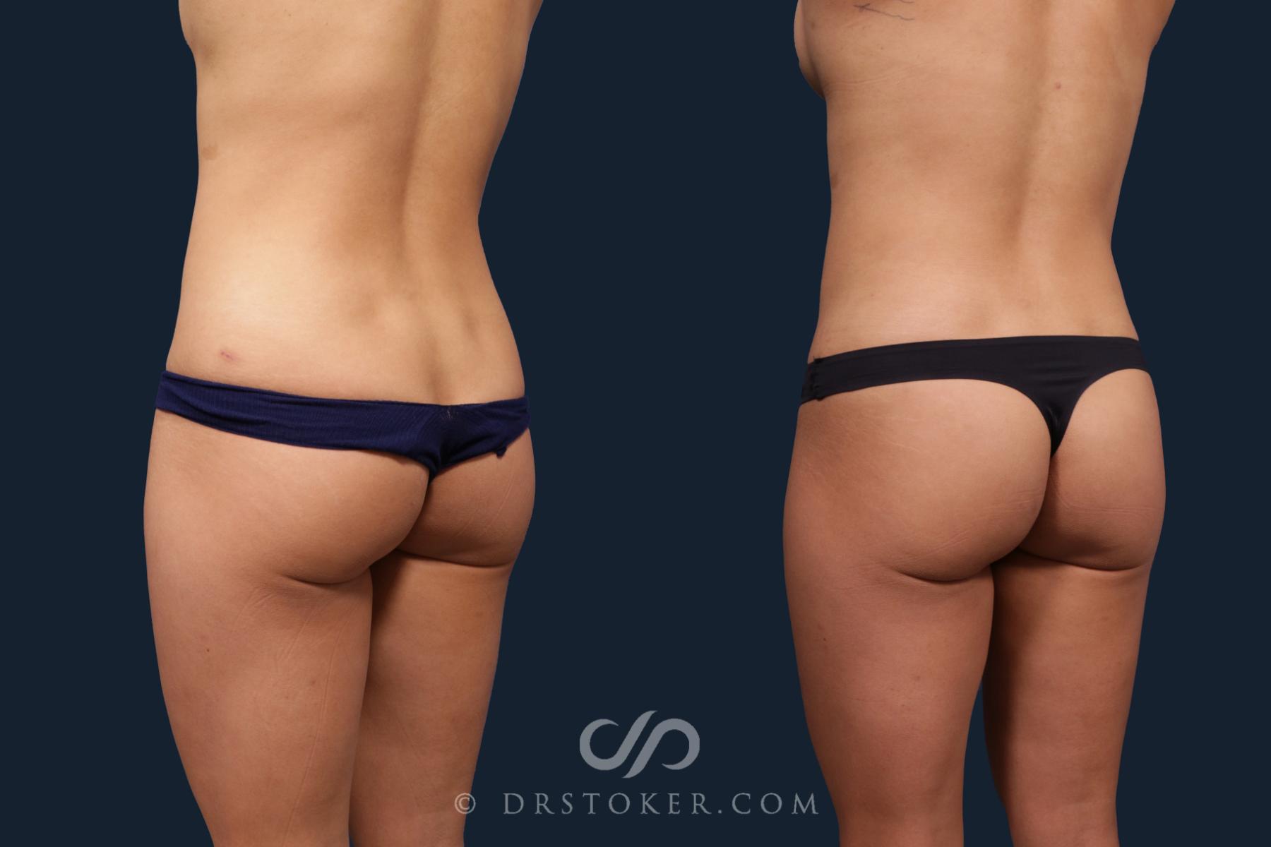 Before & After Liposuction Case 2182 Left Oblique View in Los Angeles, CA
