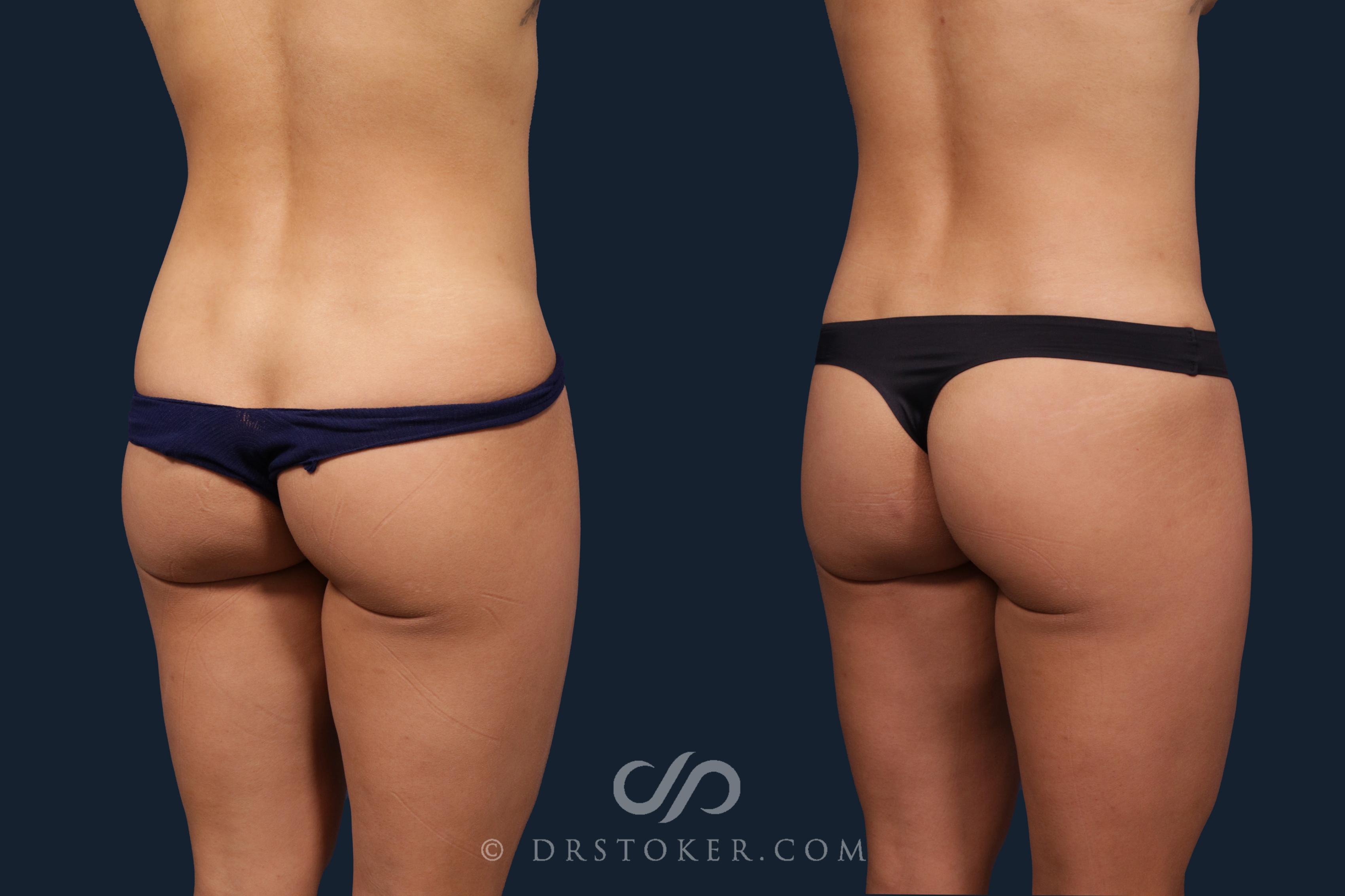 Before & After Liposuction Case 2182 Right Oblique View in Los Angeles, CA