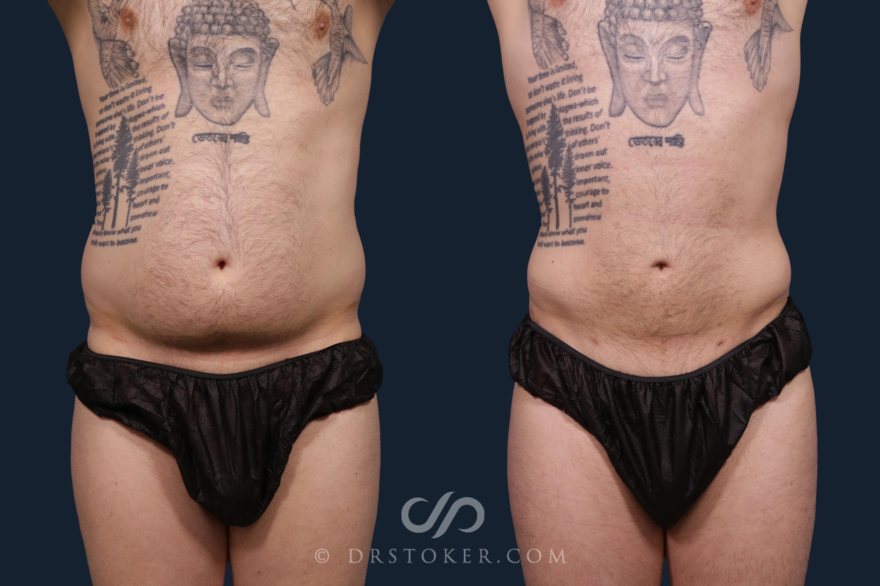 Before & After Liposuction for Men Case 2197 Front View in Los Angeles, CA