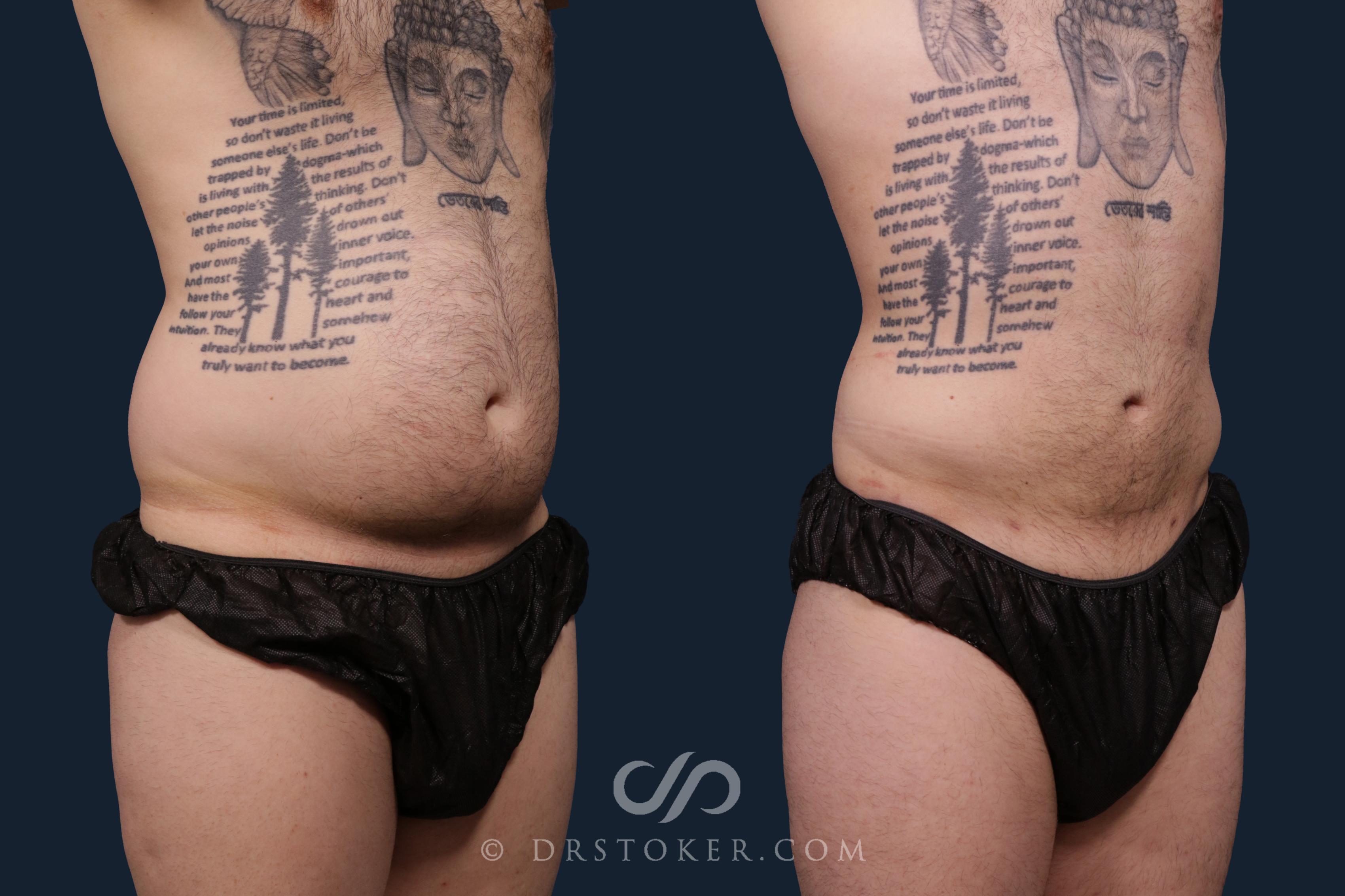 Before & After Liposuction Case 2197 Right Oblique View in Los Angeles, CA