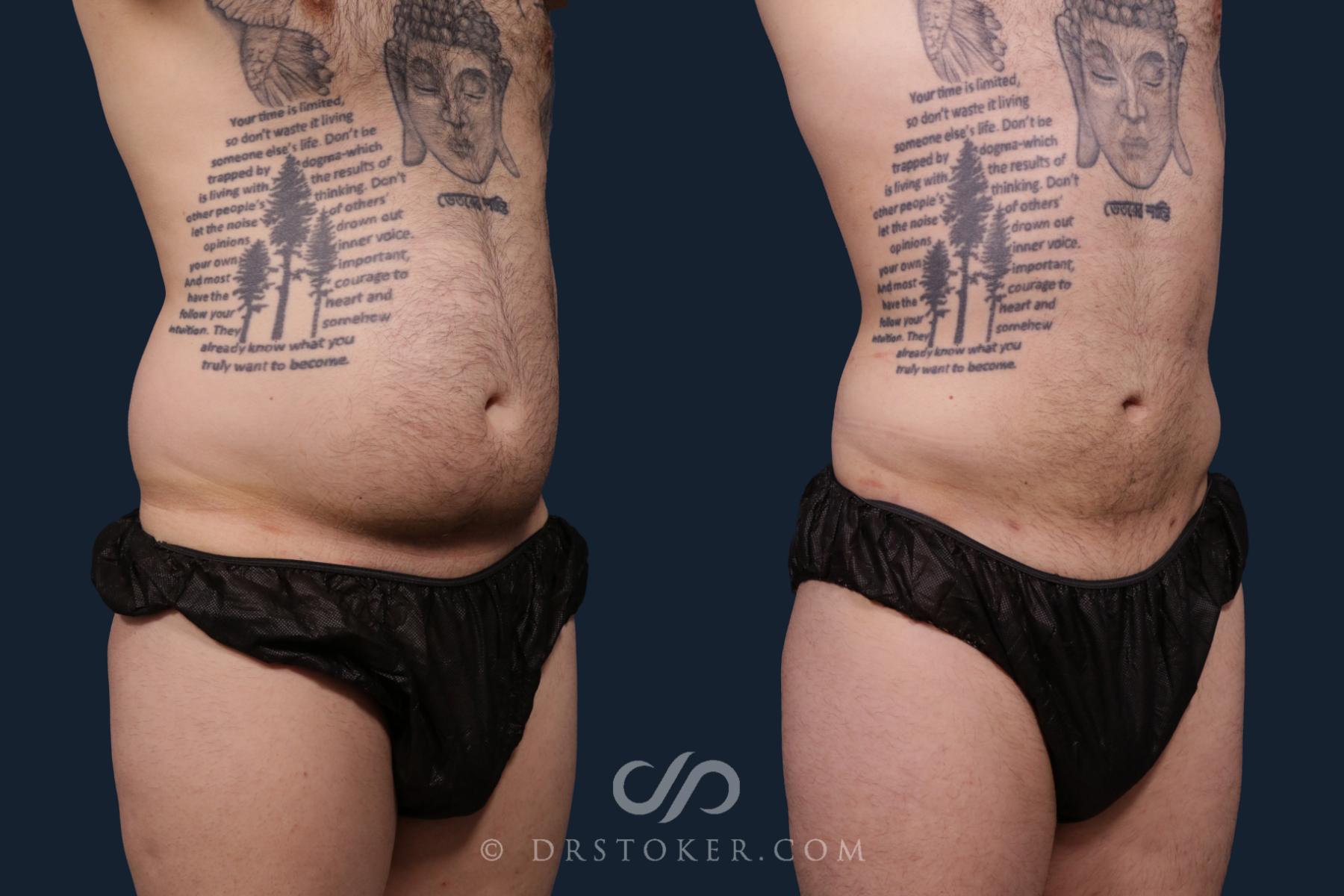 Before & After Liposuction Case 2197 Right Oblique View in Los Angeles, CA