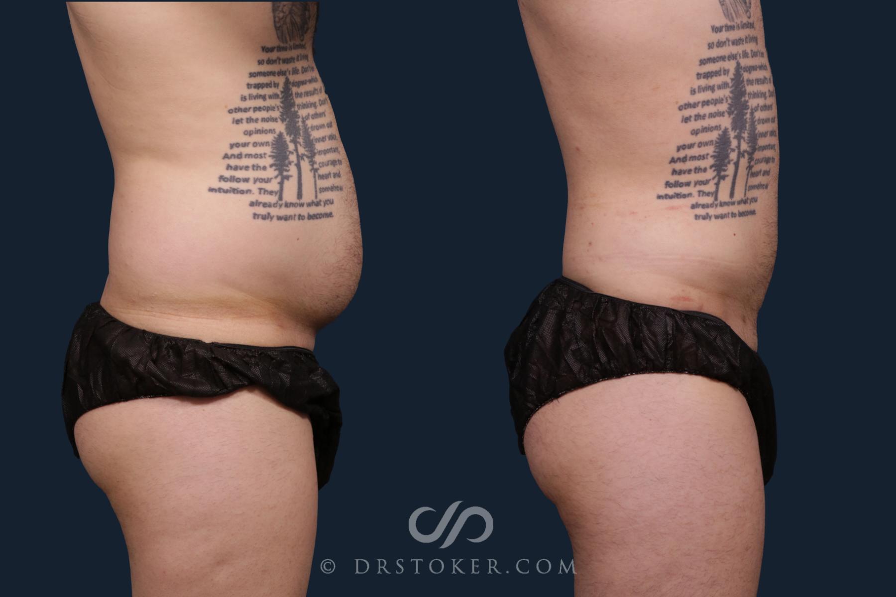 Before & After Liposuction for Men Case 2197 Right Side View in Los Angeles, CA