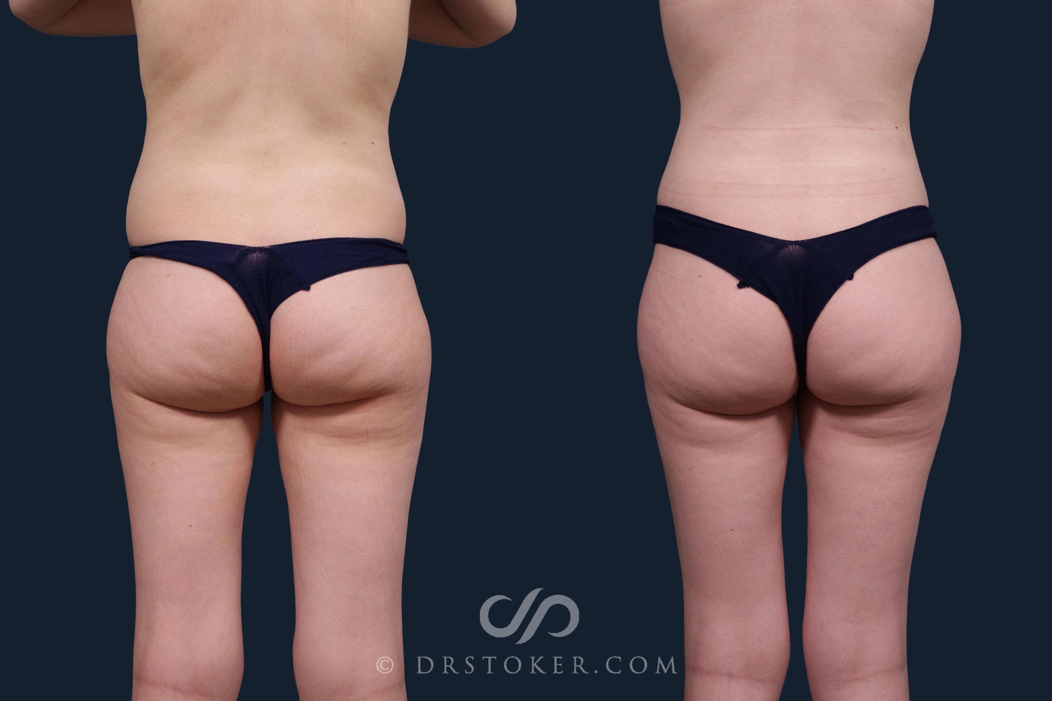 Before & After Liposuction Case 2200 Back View in Los Angeles, CA