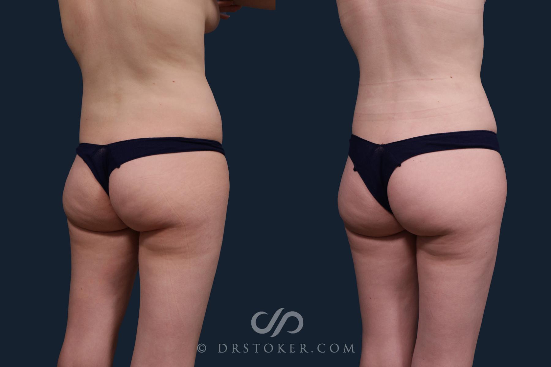 Before & After Liposuction Case 2200 Back Right  View in Los Angeles, CA