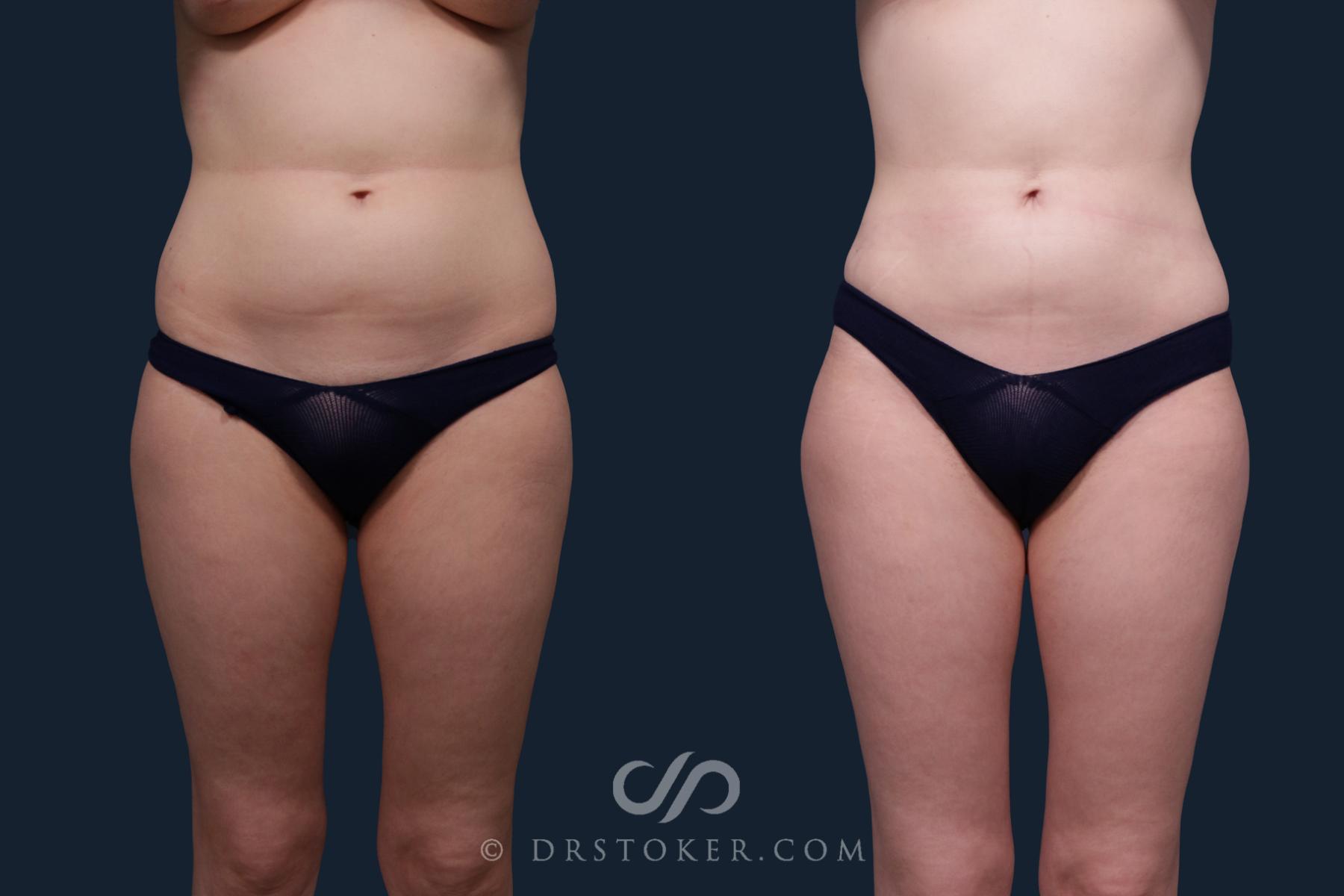 Before & After Liposuction Case 2200 Front View in Los Angeles, CA