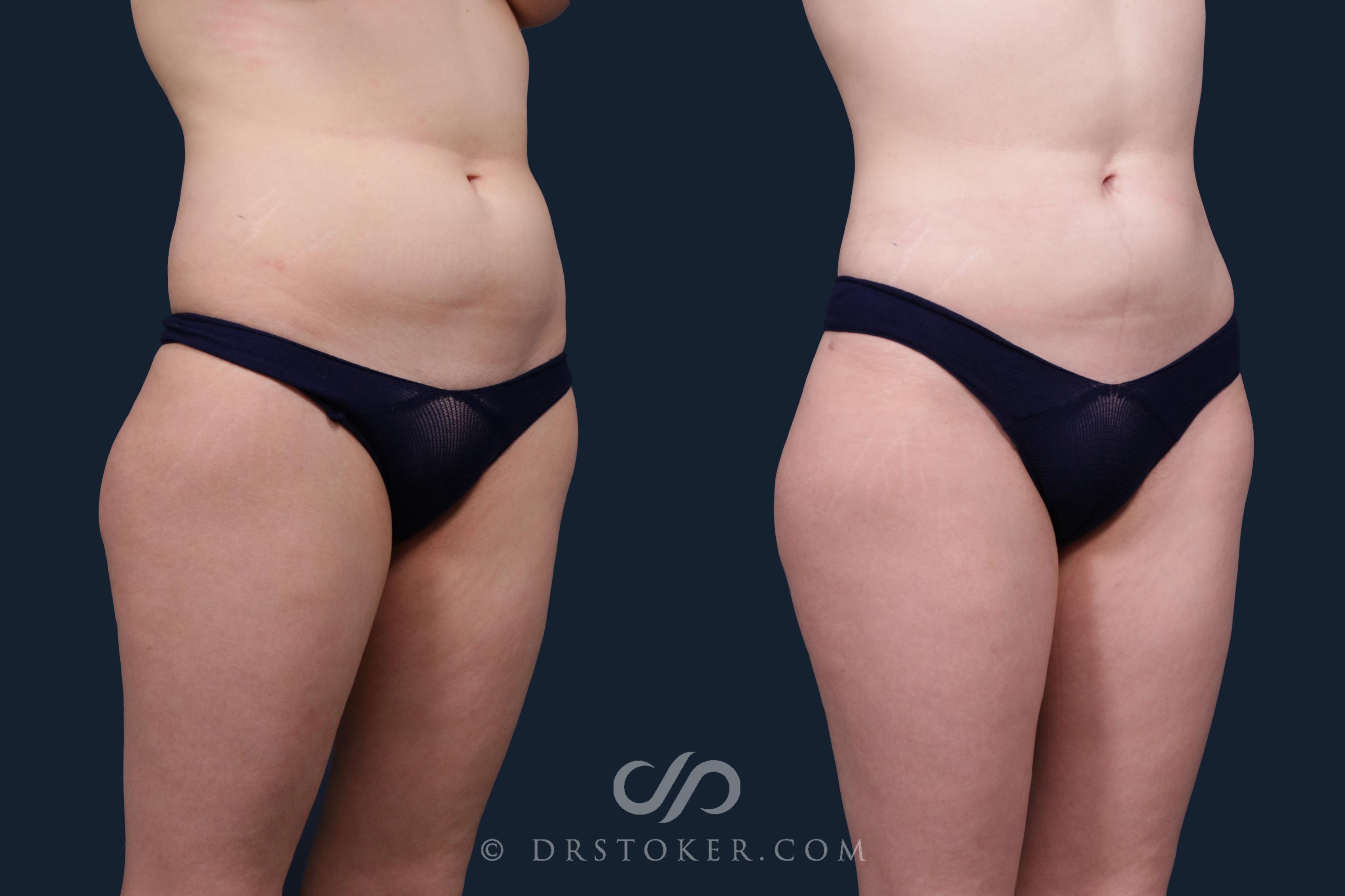 Before & After Liposuction Case 2200 Right Oblique View in Los Angeles, CA