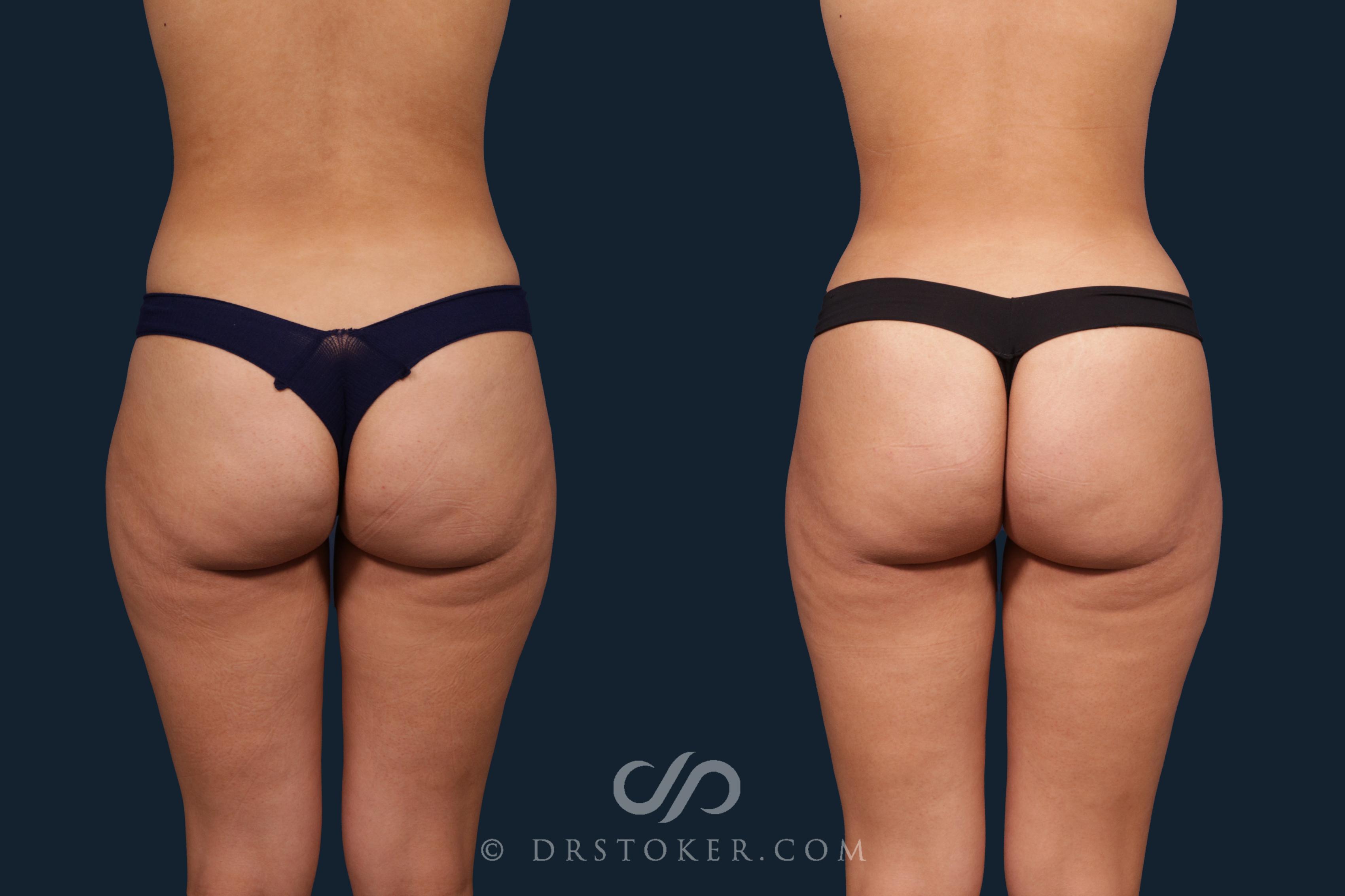 Before & After Liposuction Case 2345 Back View in Los Angeles, CA