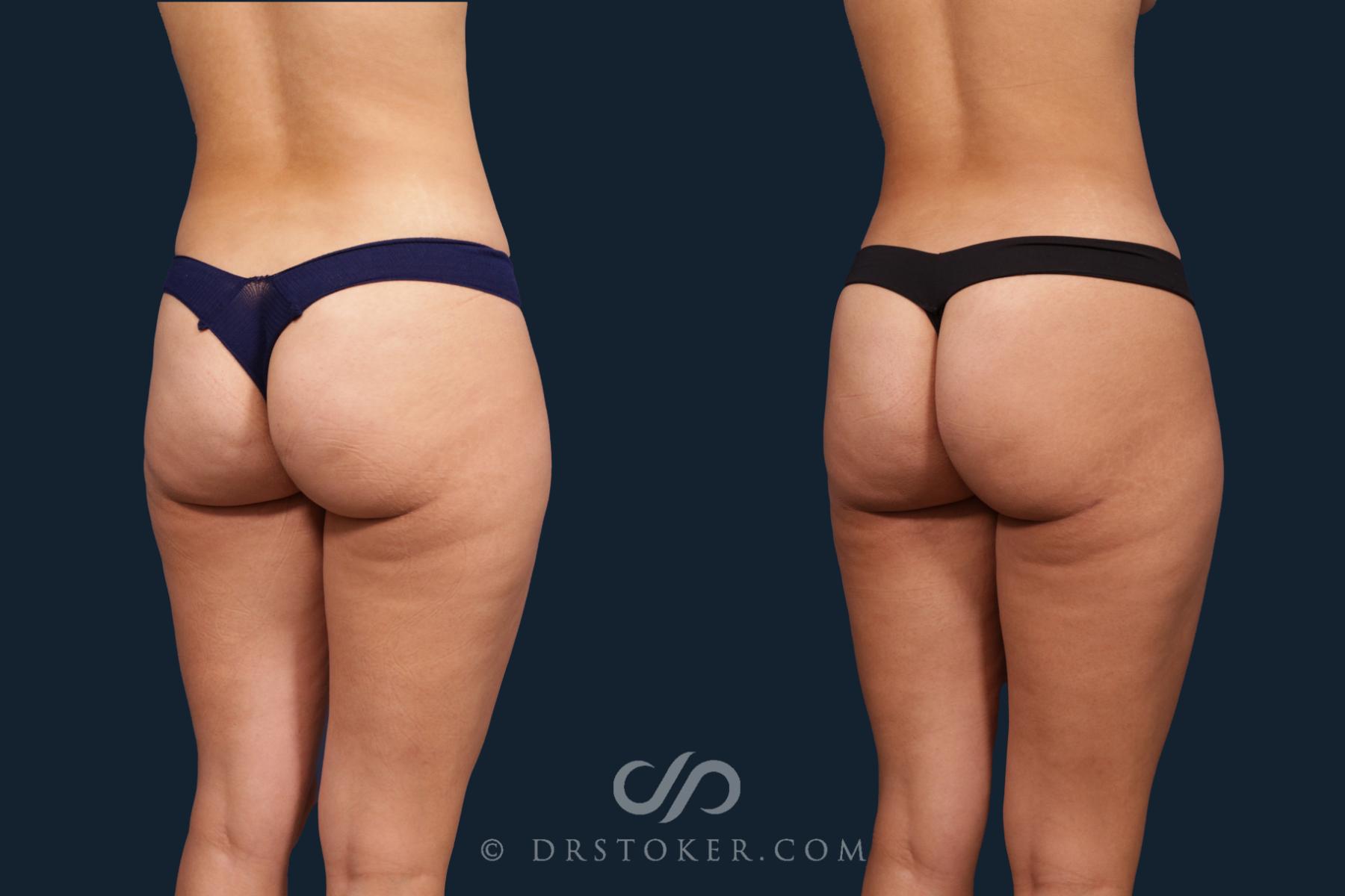 Before & After Liposuction Case 2345 Right Oblique View in Los Angeles, CA