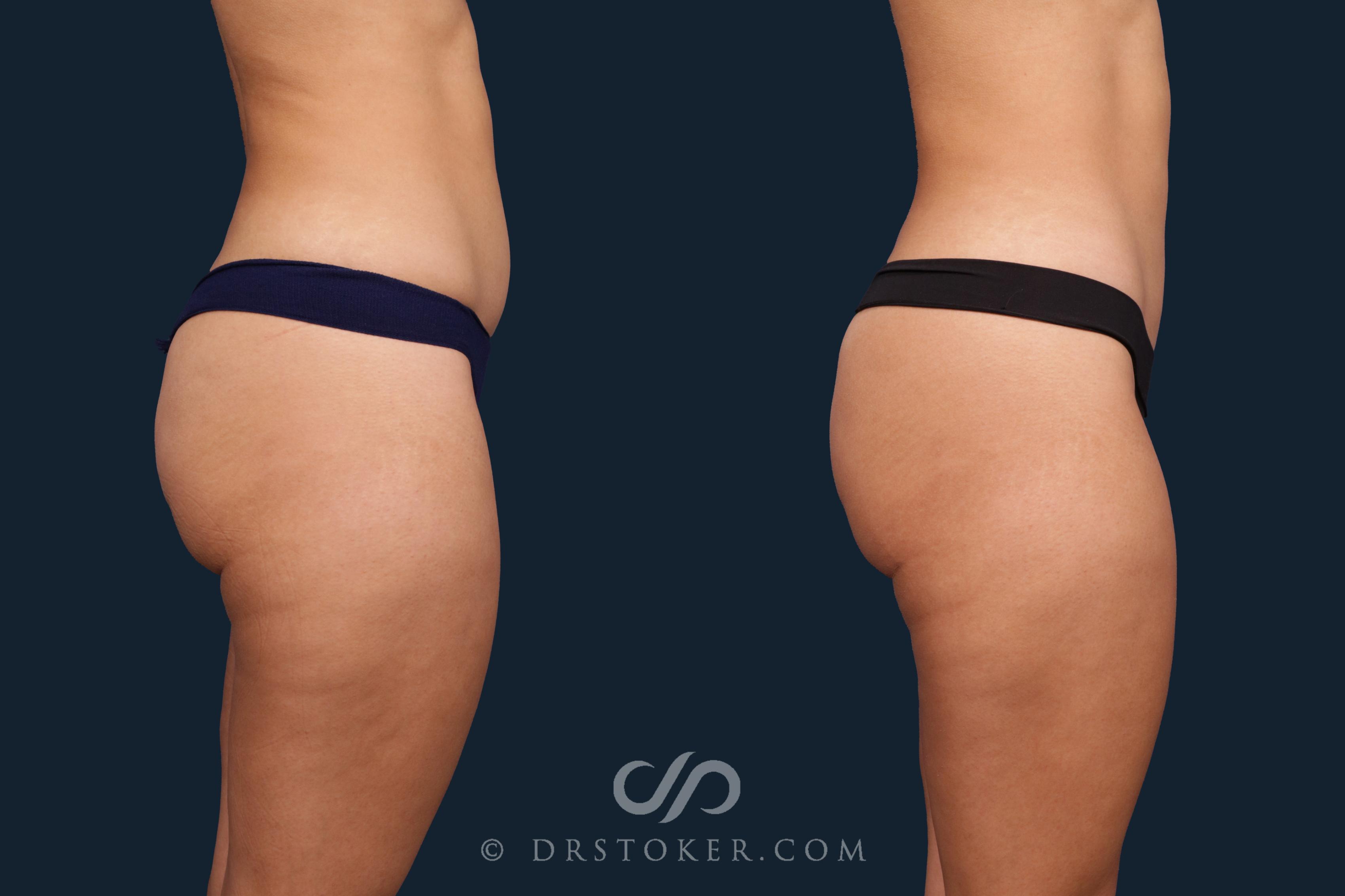 Before & After Liposuction Case 2345 Right Side View in Los Angeles, CA