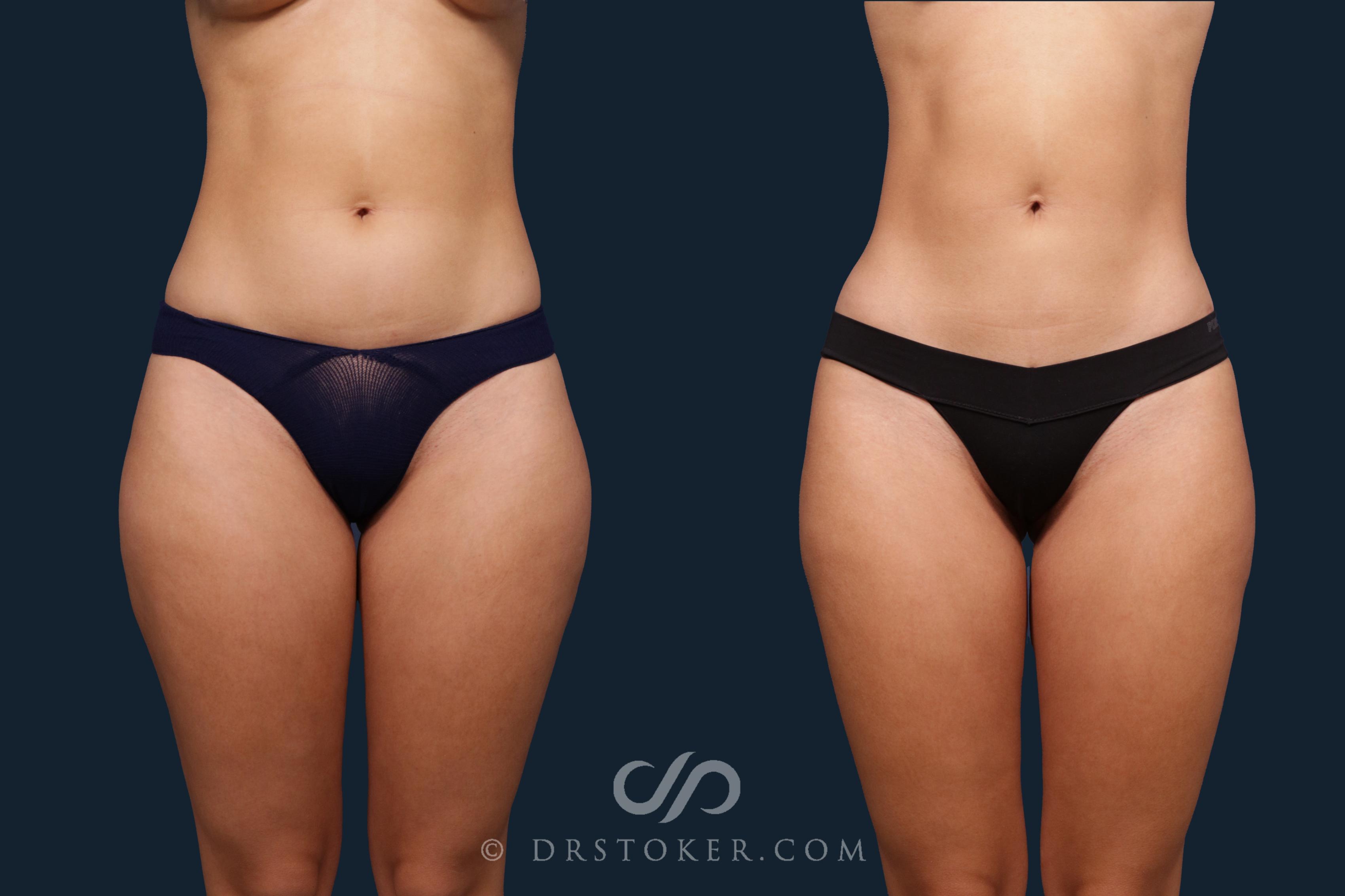 Before & After Liposuction Case 2346 Front View in Los Angeles, CA