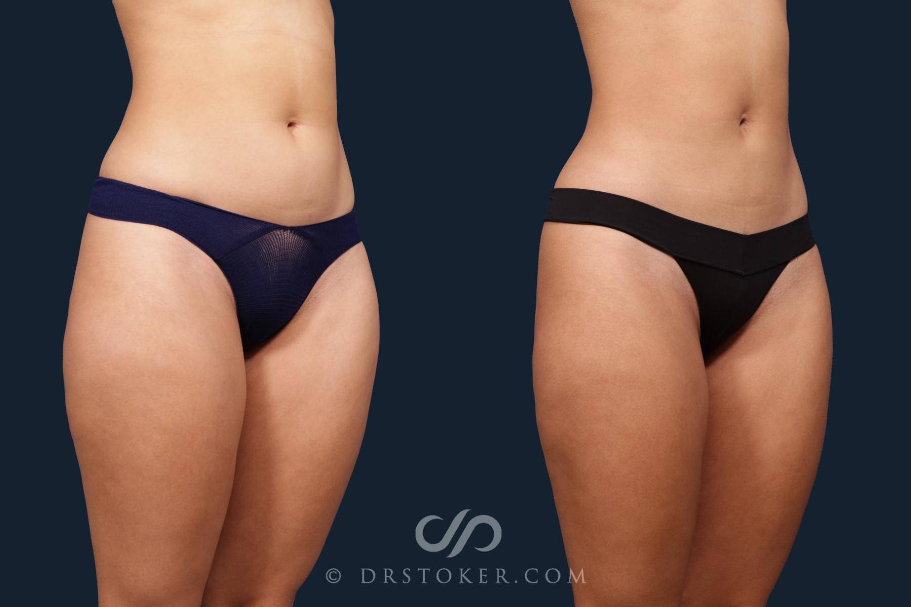 Before & After Liposuction Case 2346 Right Oblique View in Los Angeles, CA