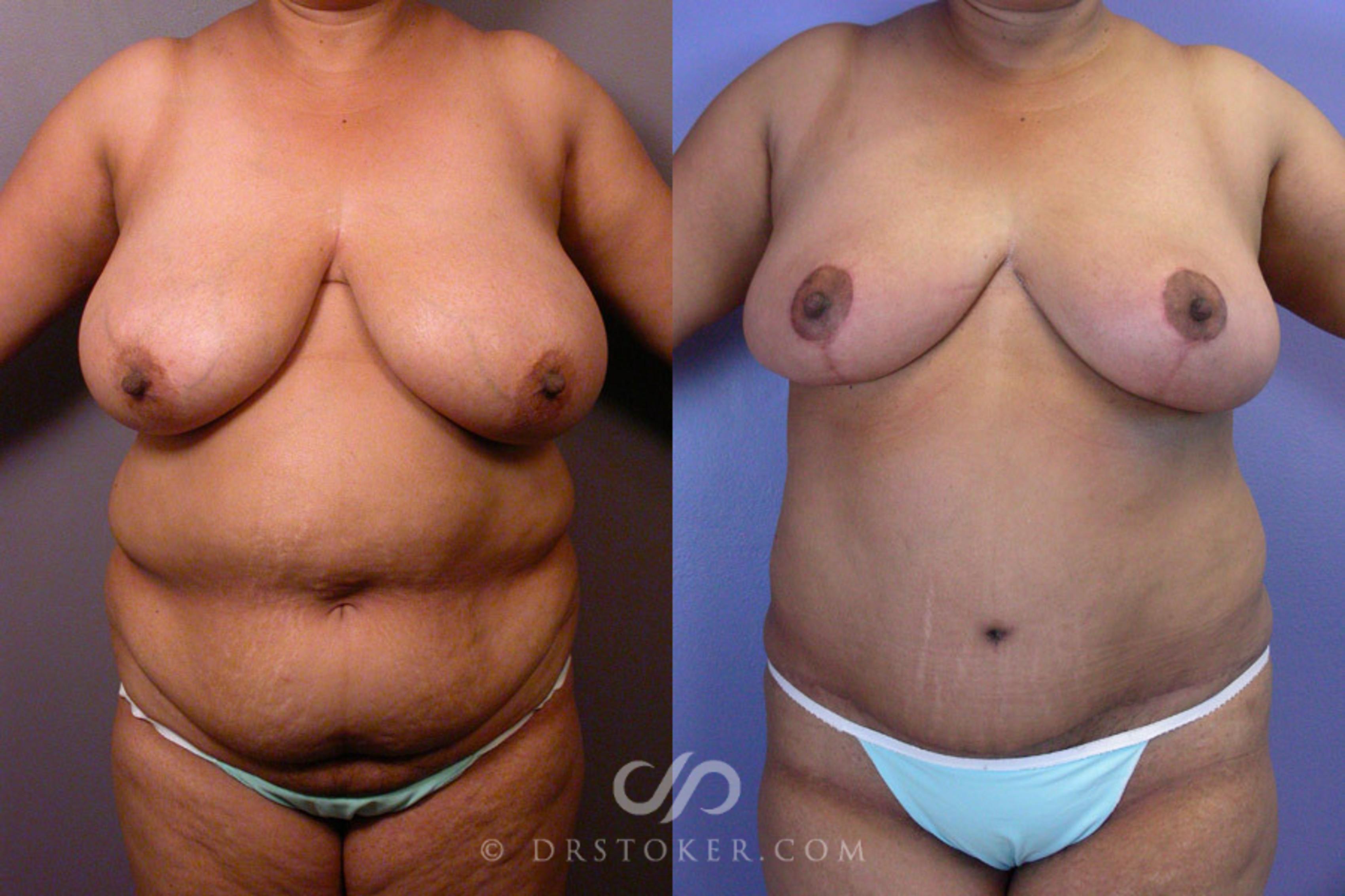 Before & After Liposuction Case 237 View #1 View in Los Angeles, CA