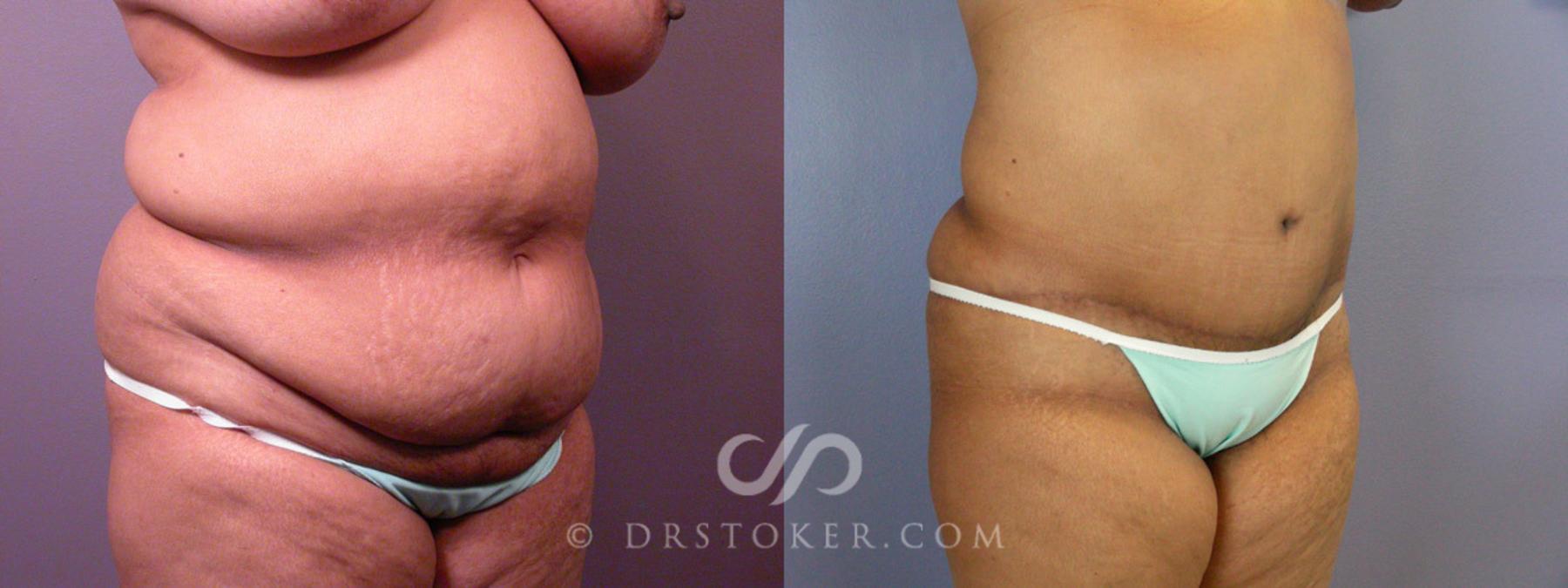 Before & After Tummy Tuck Case 237 View #10 View in Los Angeles, CA