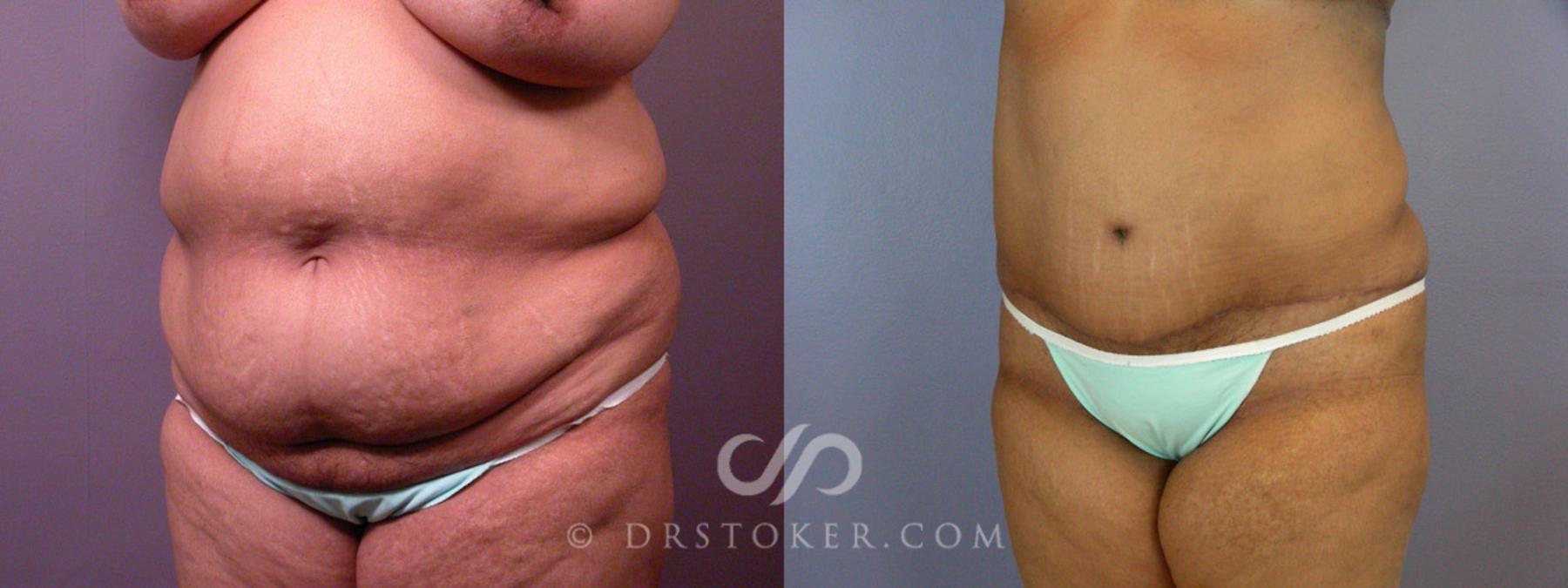Before & After Liposuction Case 237 View #11 View in Los Angeles, CA