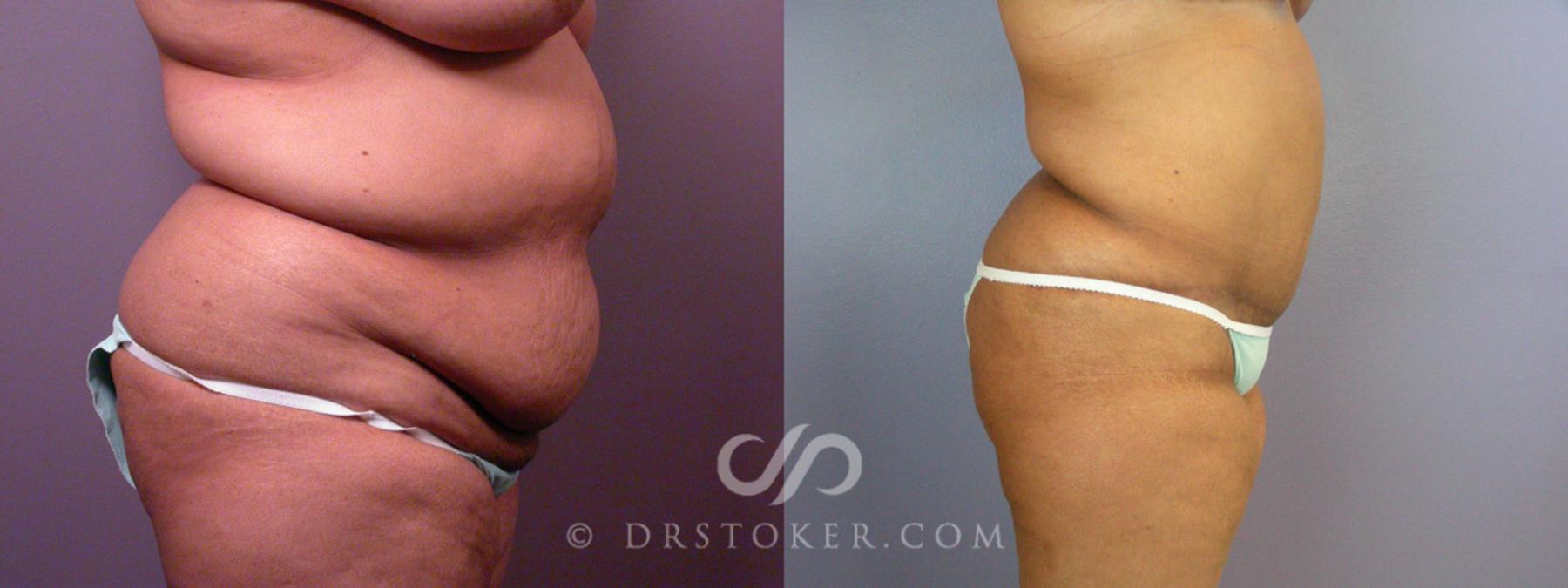Before & After Tummy Tuck Case 237 View #12 View in Los Angeles, CA