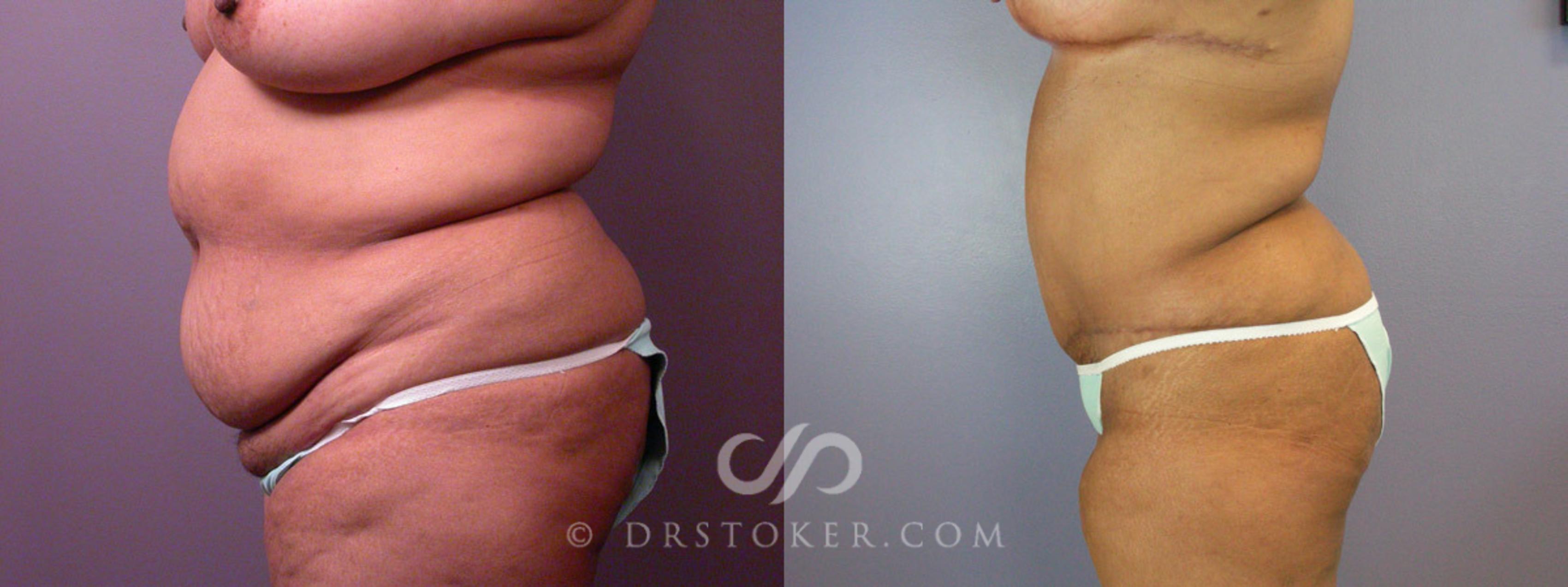 Before & After Liposuction Case 237 View #13 View in Los Angeles, CA