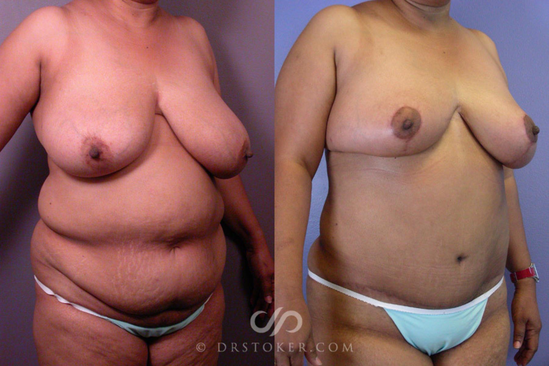 Before & After Liposuction Case 237 View #2 View in Los Angeles, CA