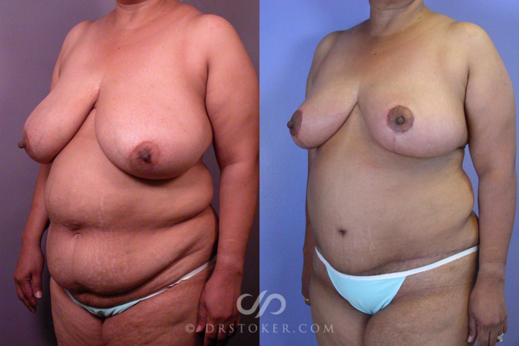 Before & After Liposuction Case 237 View #3 View in Los Angeles, CA