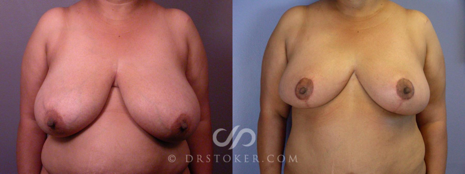 Before & After Tummy Tuck Case 237 View #4 View in Los Angeles, CA
