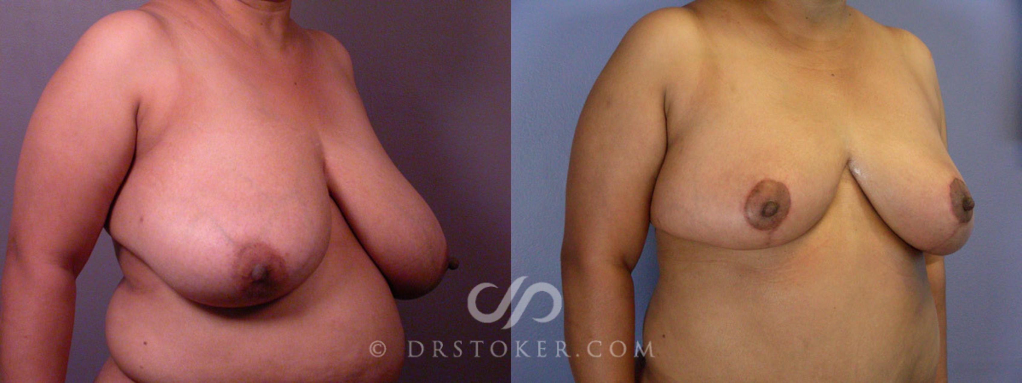 Before & After Liposuction Case 237 View #5 View in Los Angeles, CA