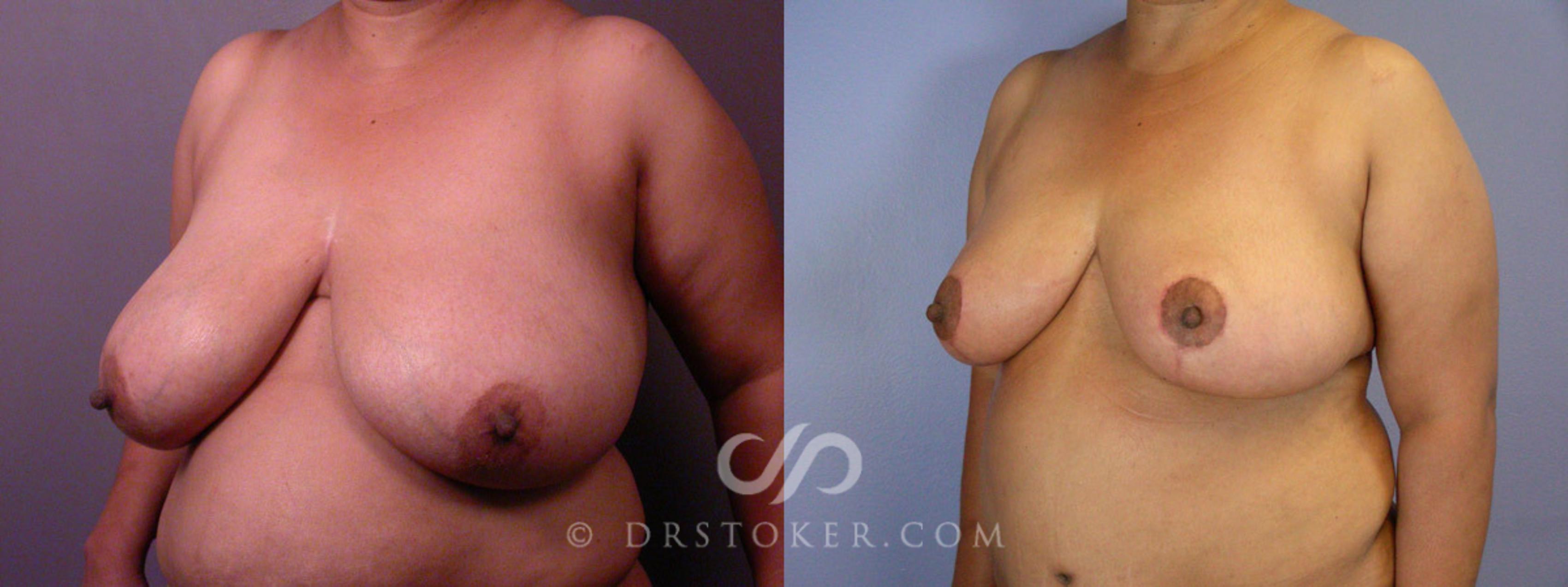 Before & After Liposuction Case 237 View #6 View in Los Angeles, CA