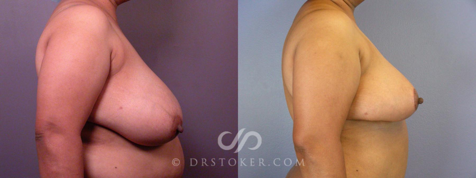 Before & After Tummy Tuck Case 237 View #7 View in Los Angeles, CA