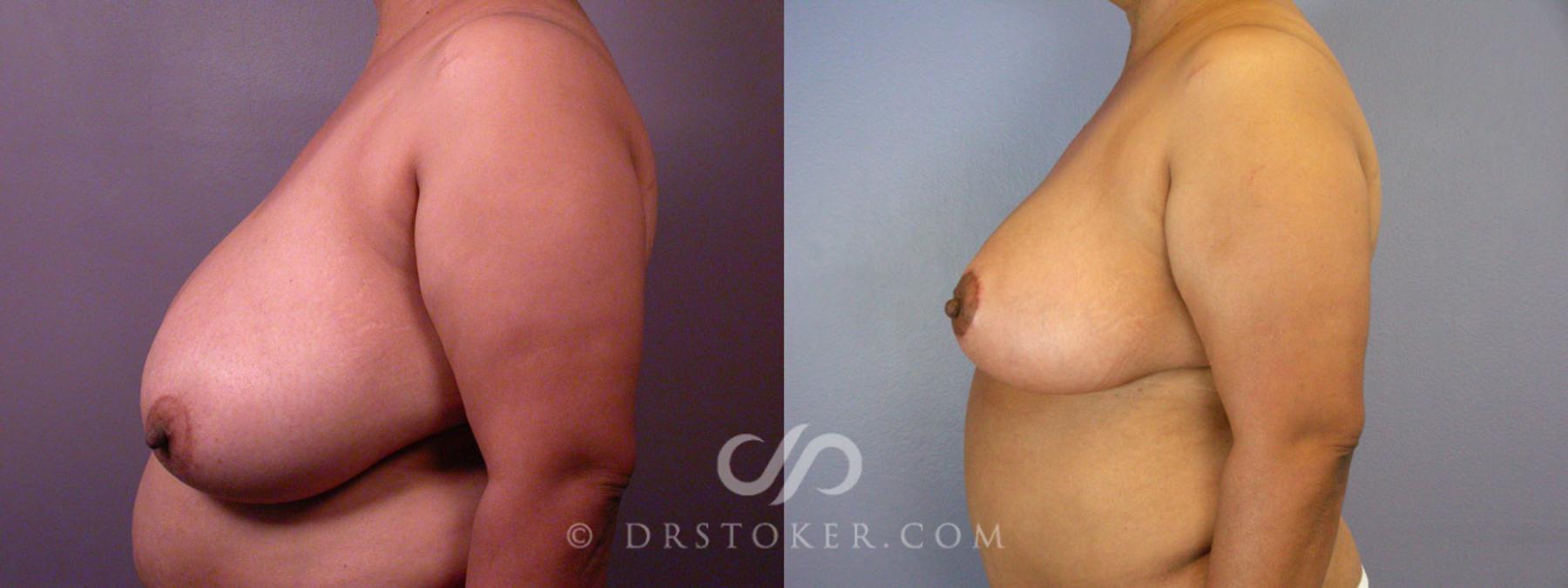 Before & After Liposuction Case 237 View #8 View in Los Angeles, CA