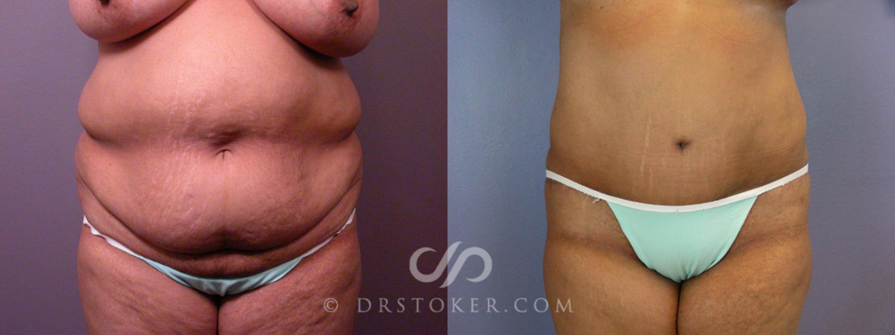 Before & After Liposuction Case 237 View #9 View in Los Angeles, CA