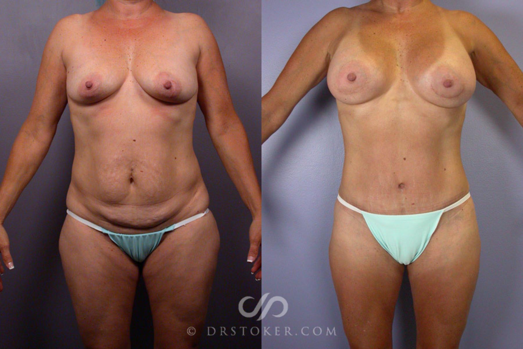 Before & After Liposuction Case 244 View #1 View in Los Angeles, CA