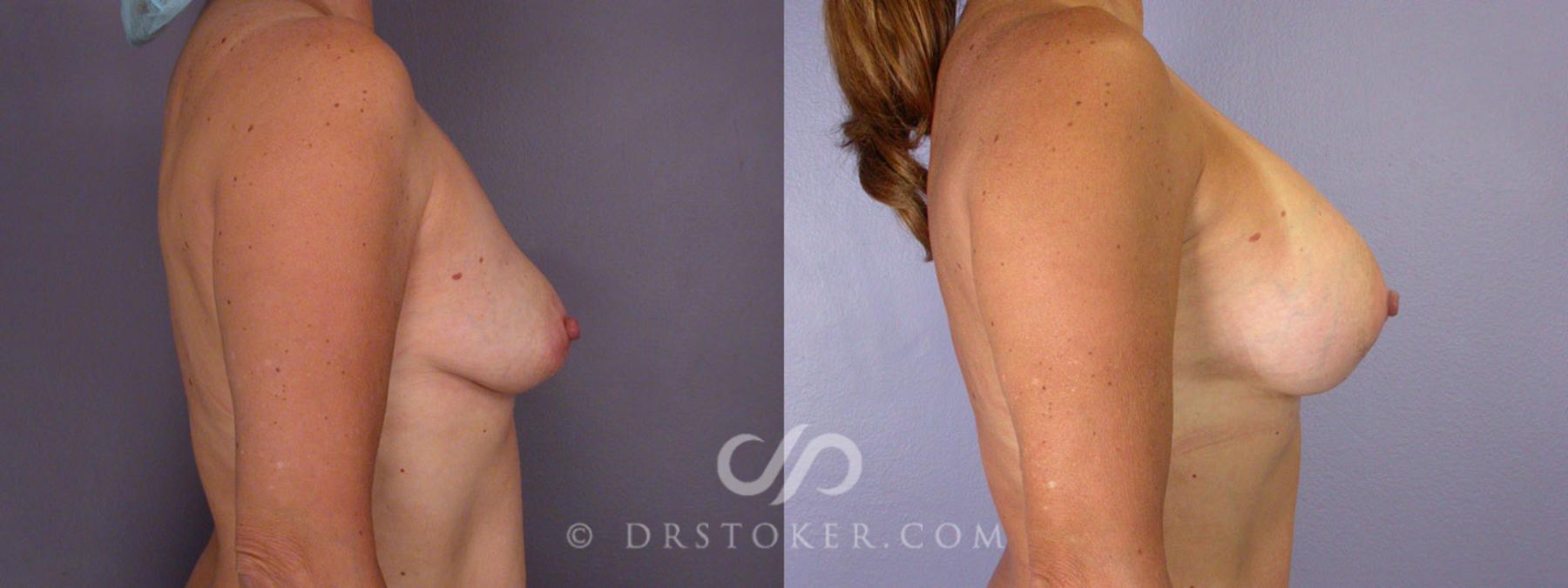 Before & After Tummy Tuck Case 244 View #10 View in Los Angeles, CA