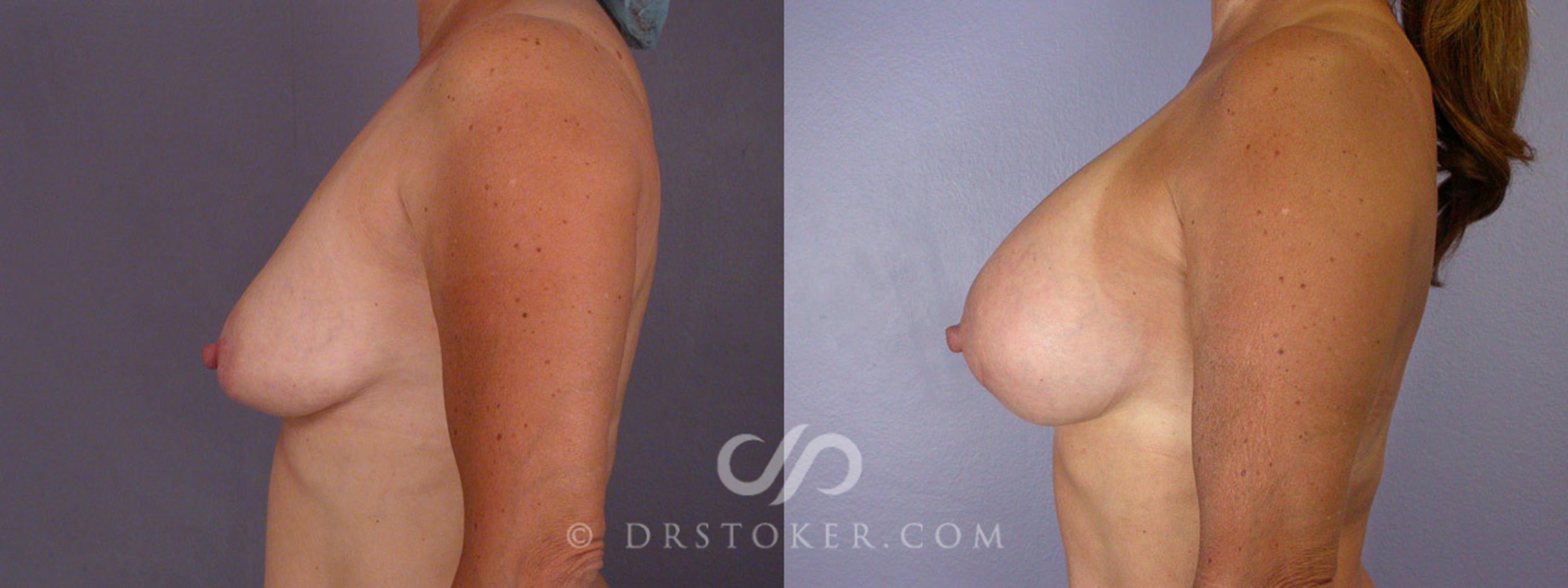 Before & After Liposuction Case 244 View #11 View in Los Angeles, CA