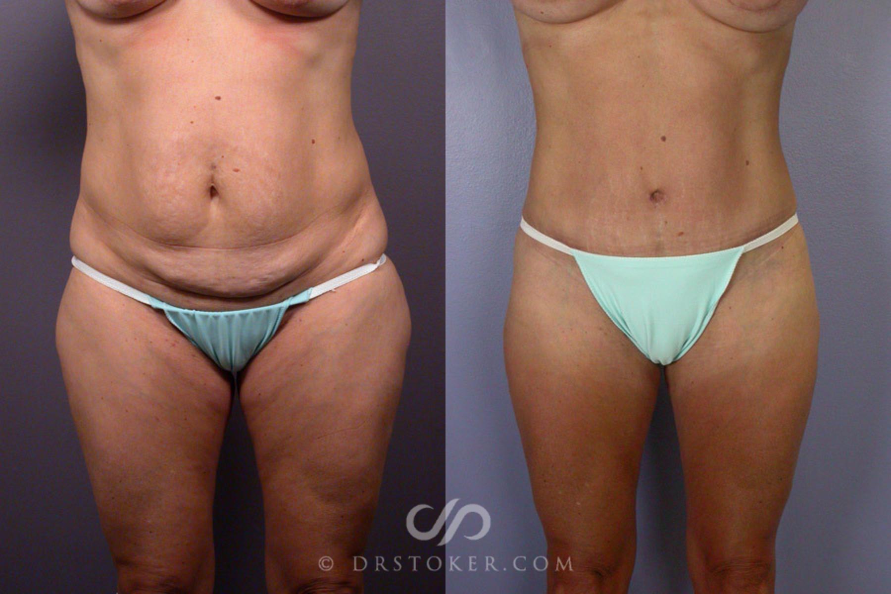 Before & After Liposuction Case 244 View #2 View in Los Angeles, CA