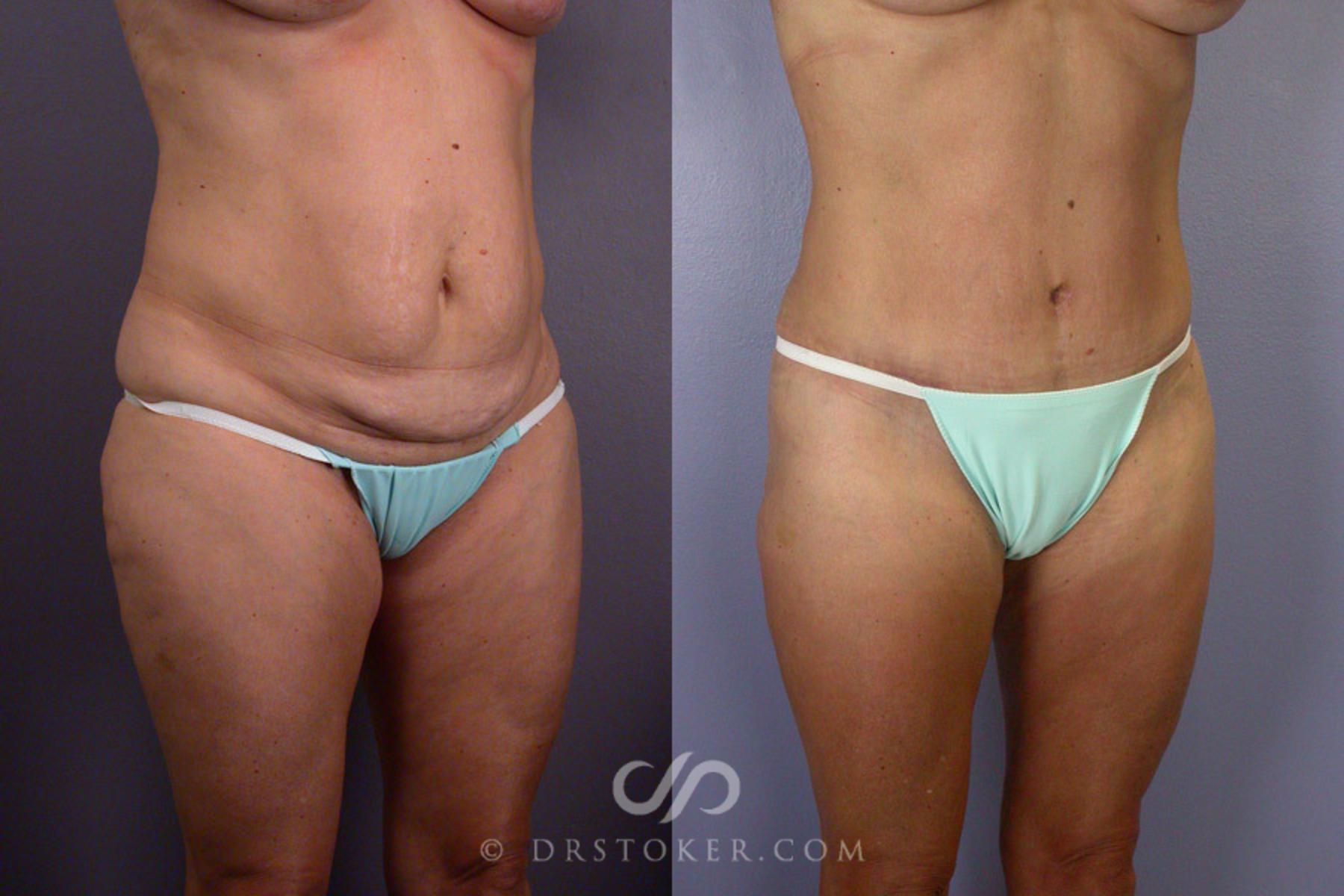 Before & After Liposuction Case 244 View #3 View in Los Angeles, CA