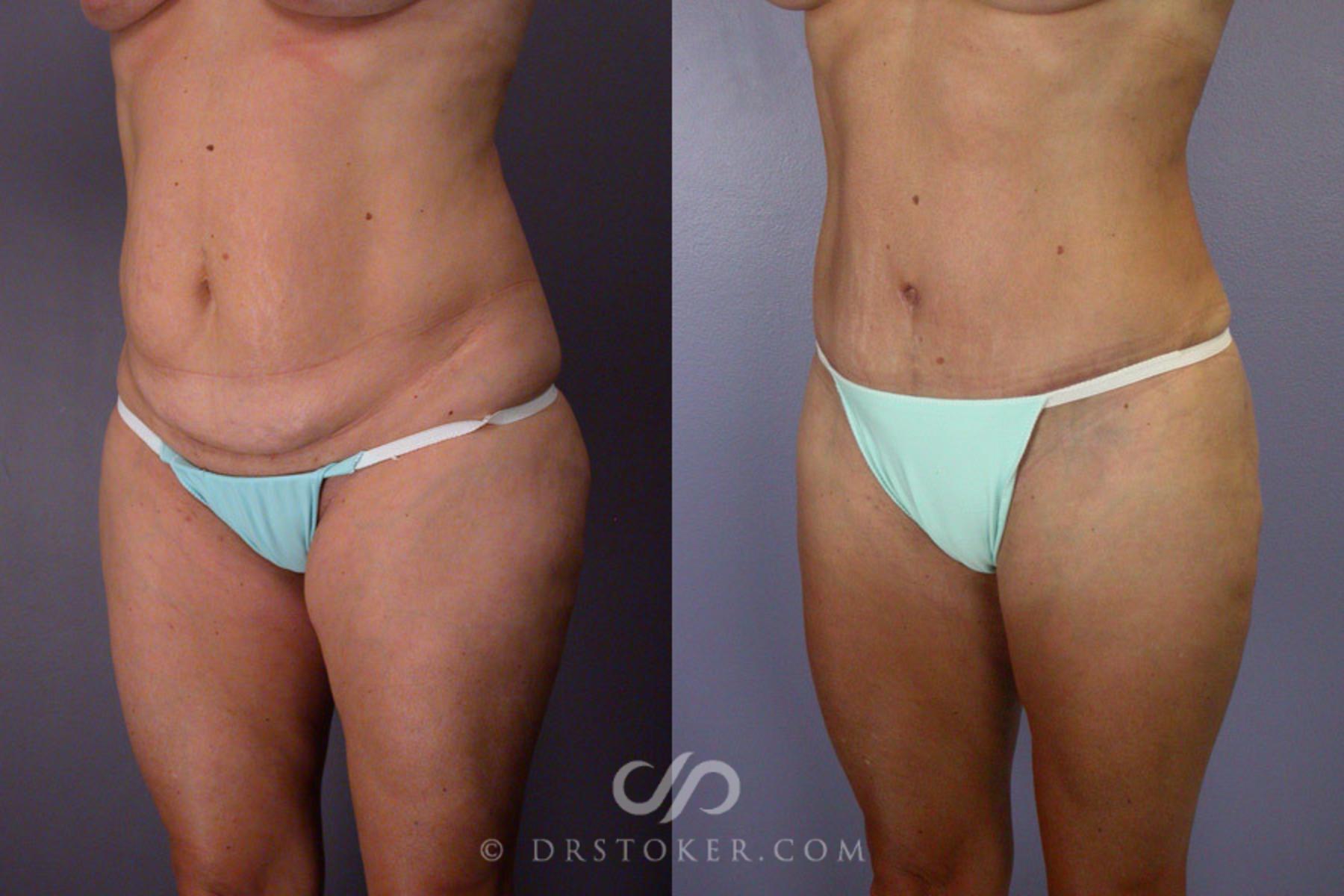 Before & After Tummy Tuck Case 244 View #4 View in Los Angeles, CA
