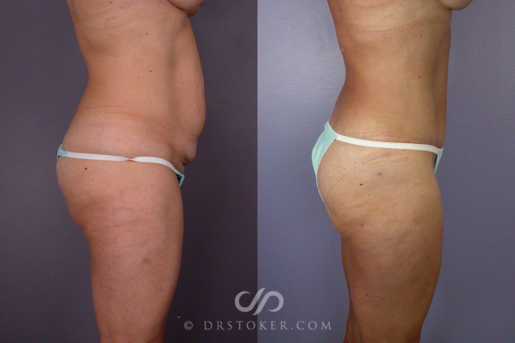 Before & After Liposuction Case 244 View #5 View in Los Angeles, CA
