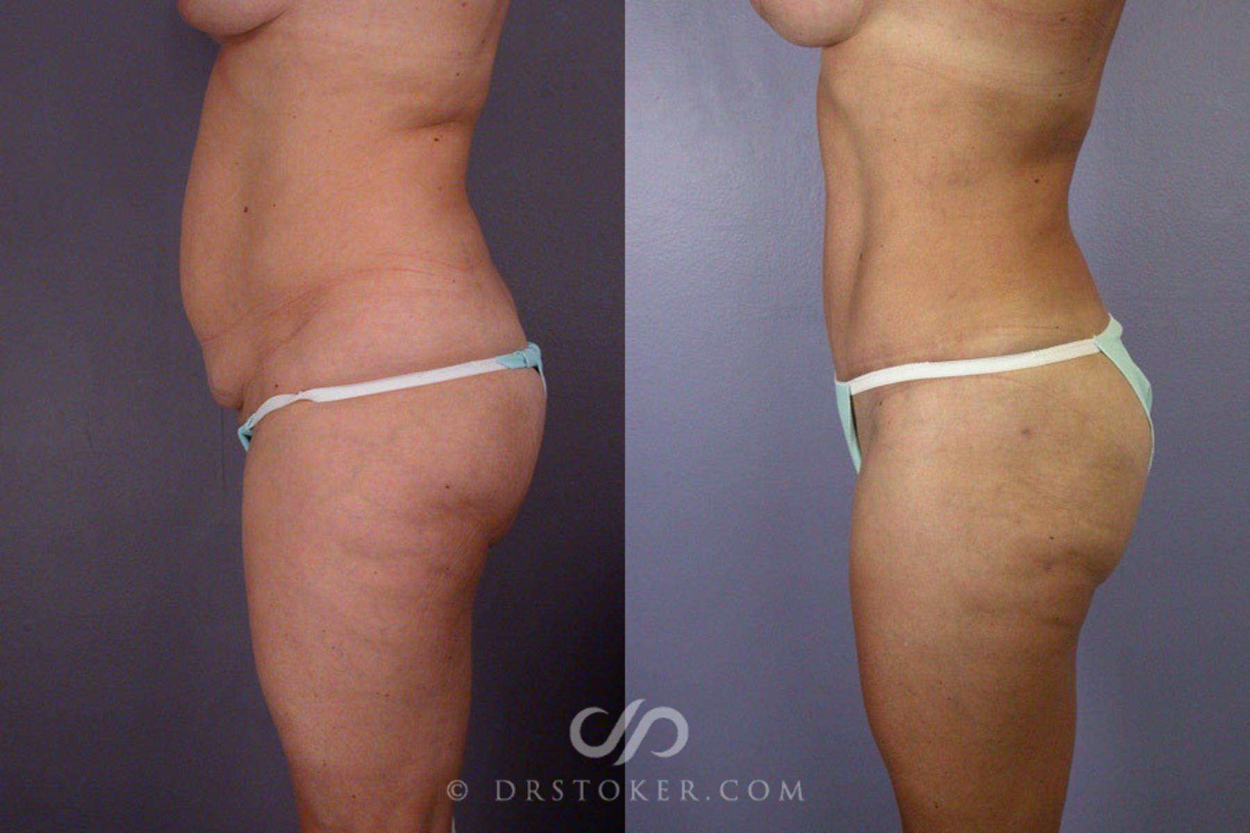 Before & After Tummy Tuck Case 244 View #6 View in Los Angeles, CA