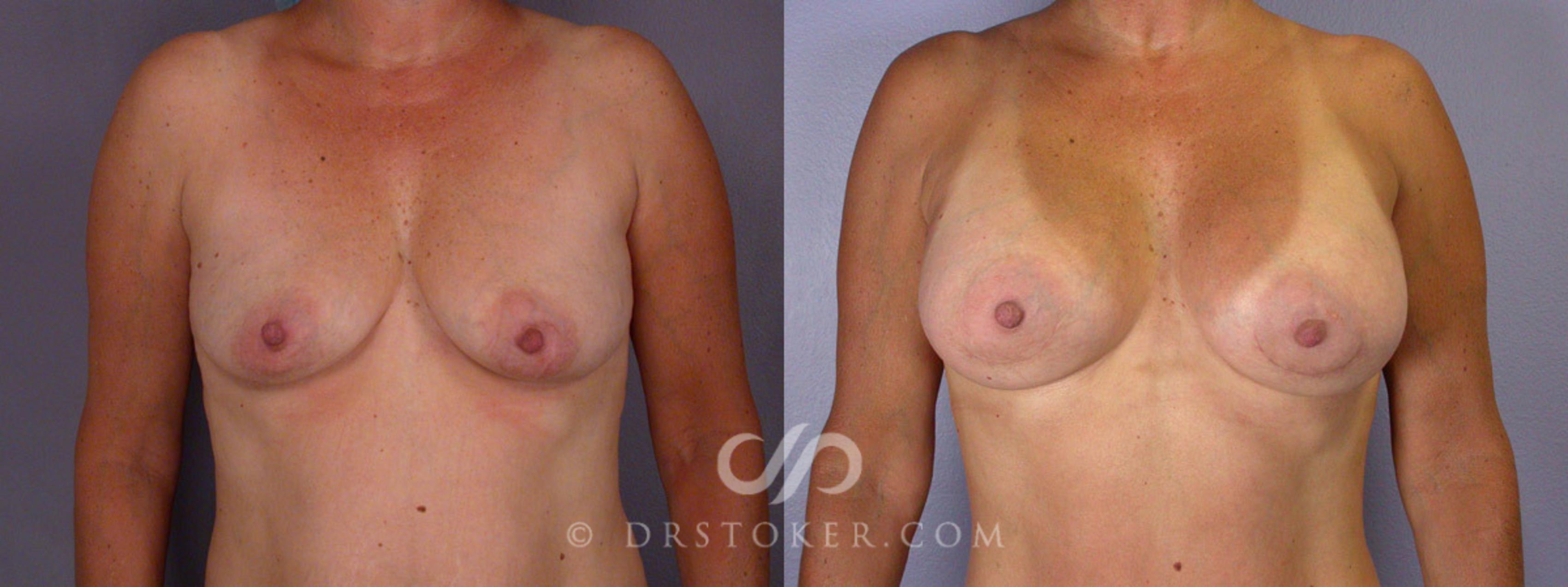 Before & After Liposuction Case 244 View #7 View in Los Angeles, CA