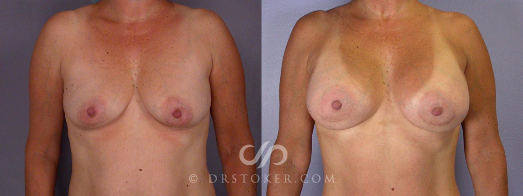 Before & After Liposuction Case 244 View #7 View in Los Angeles, CA