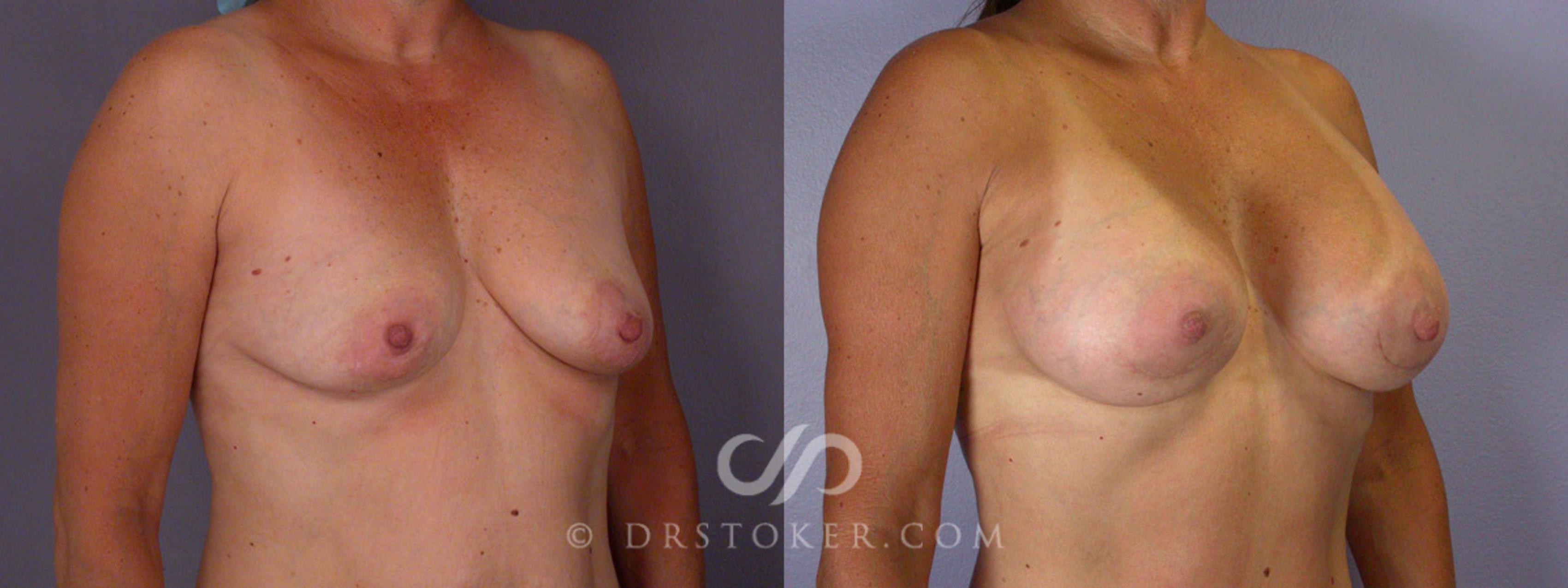 Before & After Liposuction Case 244 View #8 View in Los Angeles, CA