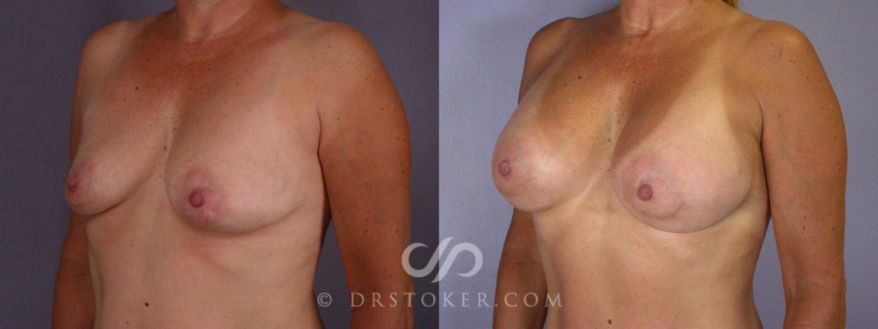 Before & After Liposuction Case 244 View #9 View in Los Angeles, CA