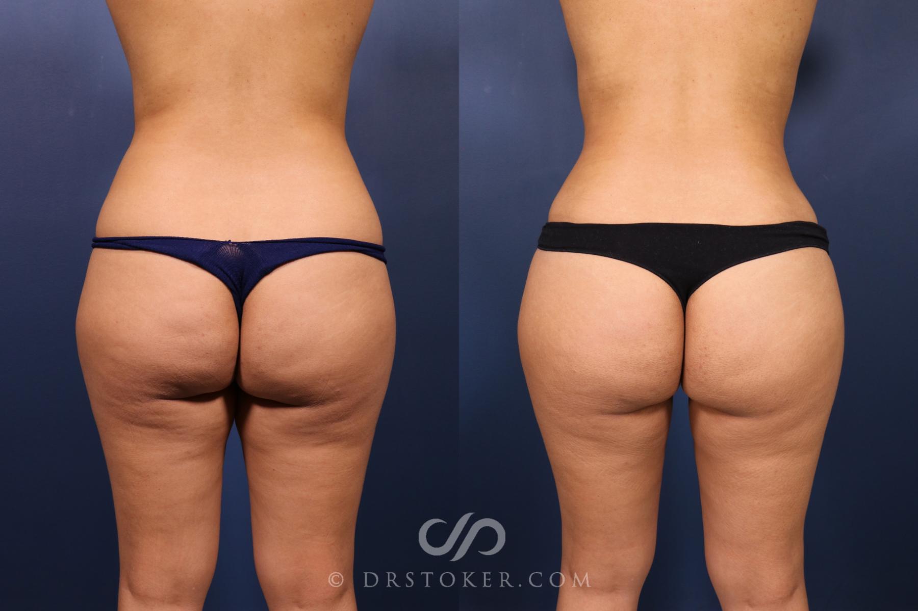 Before & After Liposuction Case 2489 Back View in Los Angeles, CA