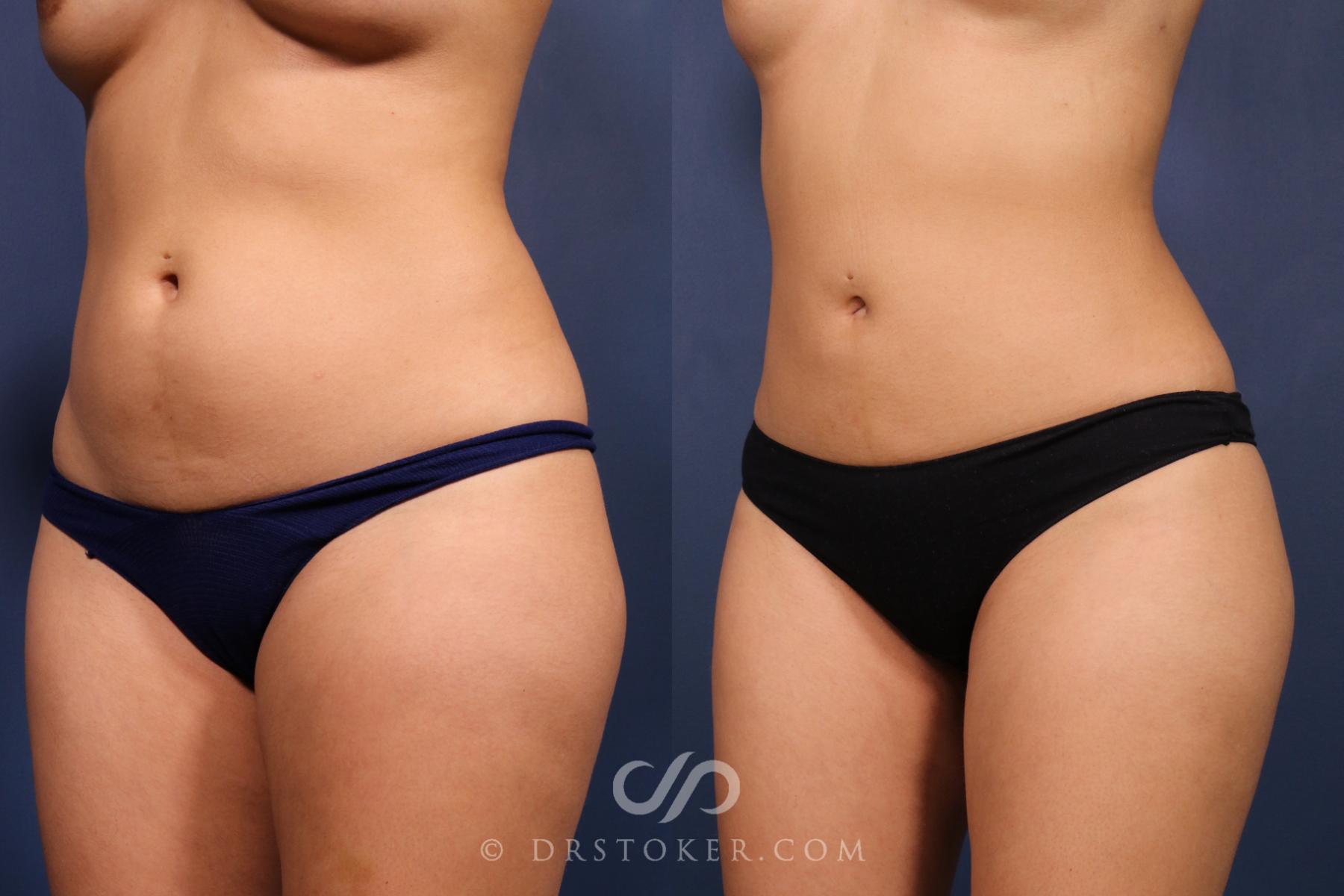 Before & After Liposuction Case 2489 Front Left Obliques View in Los Angeles, CA