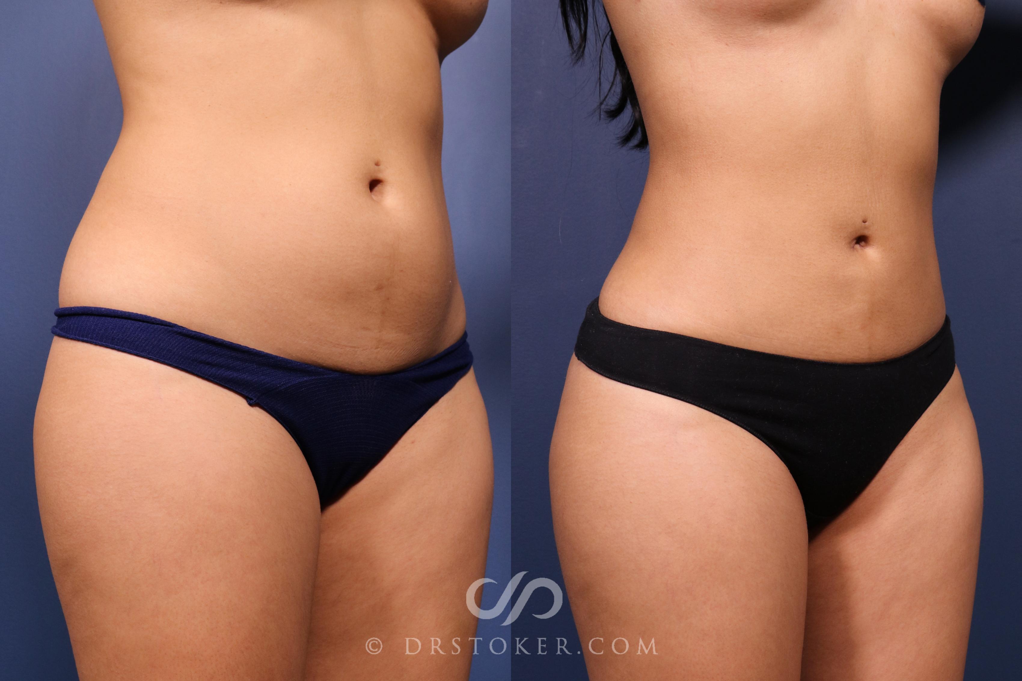 Before & After Liposuction Case 2489 Front Right Obliques View in Los Angeles, CA