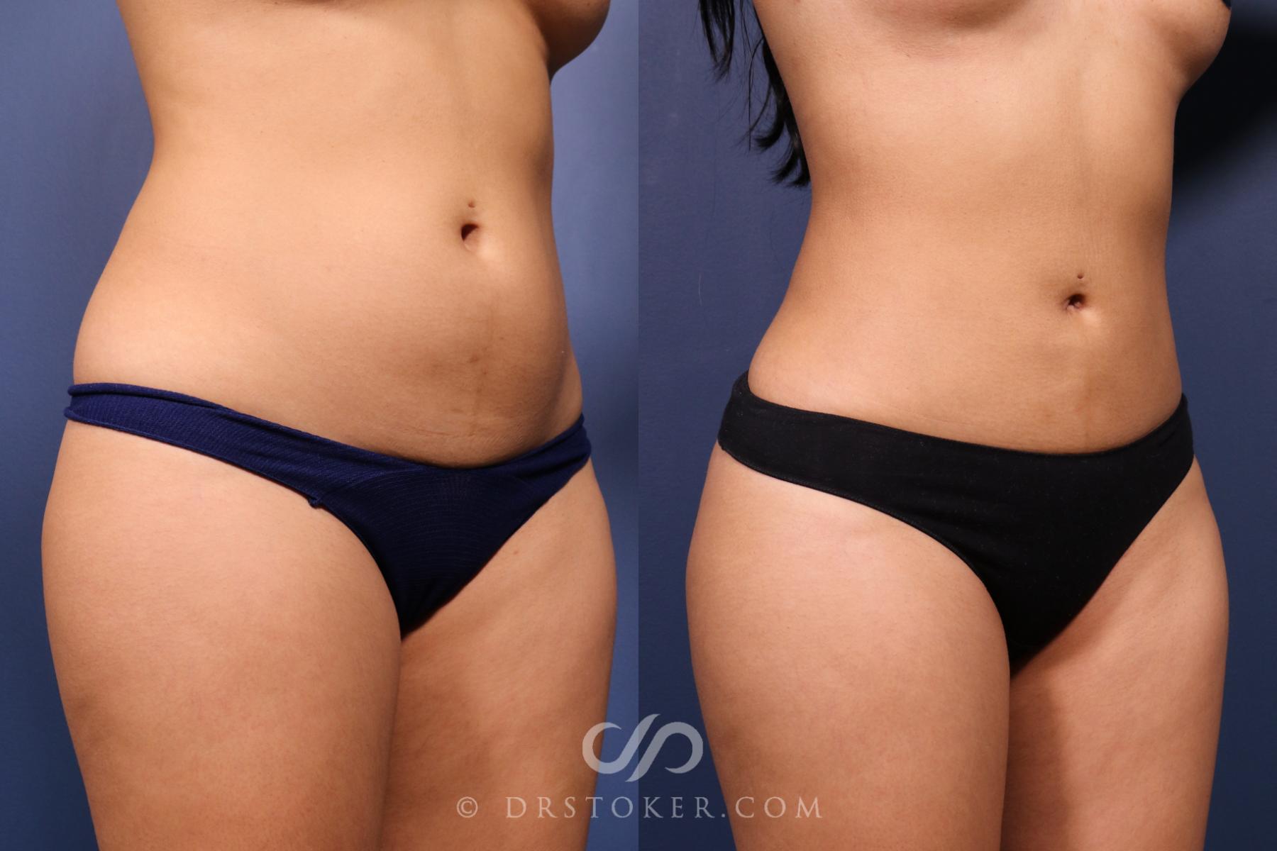 Before & After Liposuction Case 2489 Front Right Obliques View in Los Angeles, CA