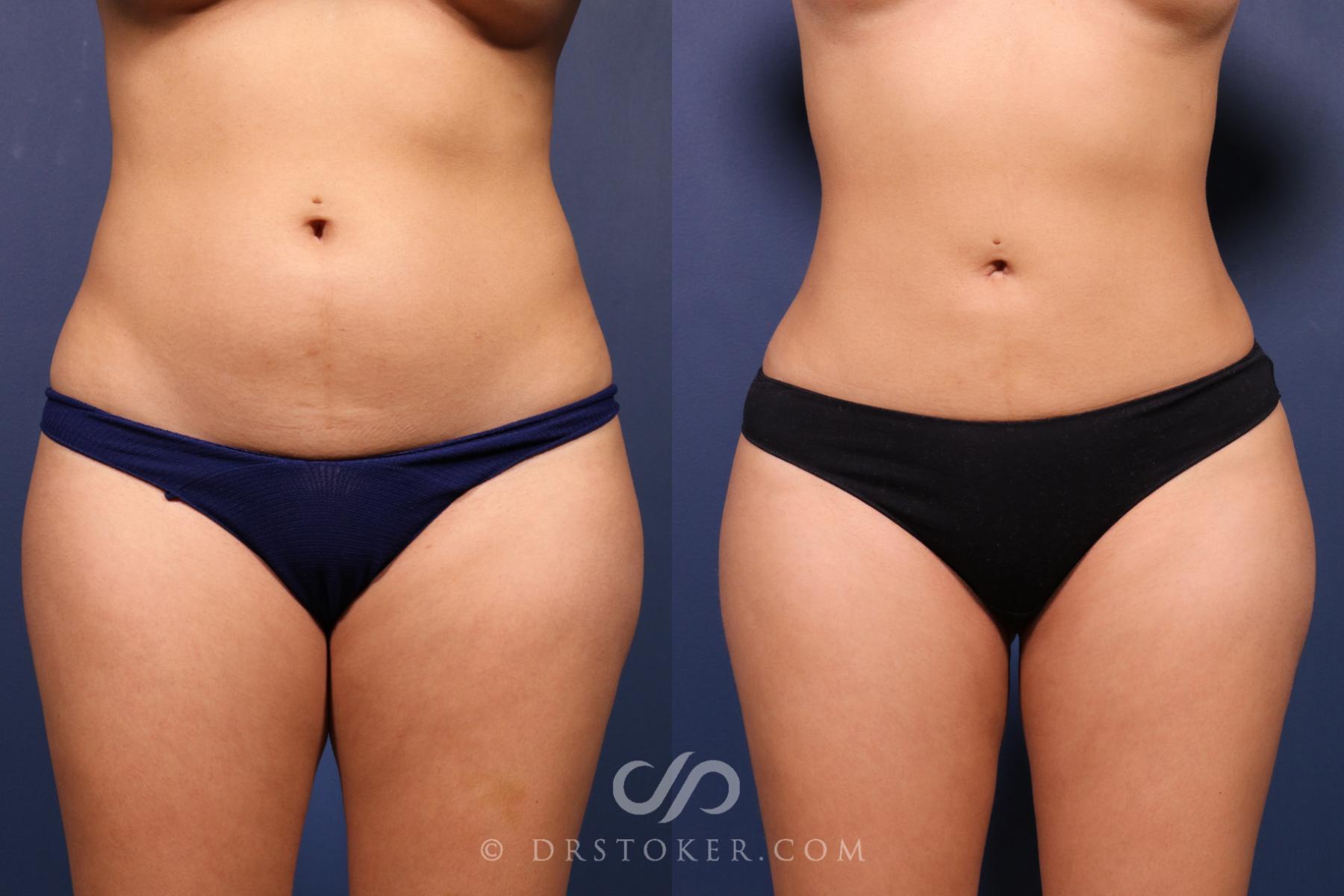 Before & After Liposuction Case 2489 Front View in Los Angeles, CA