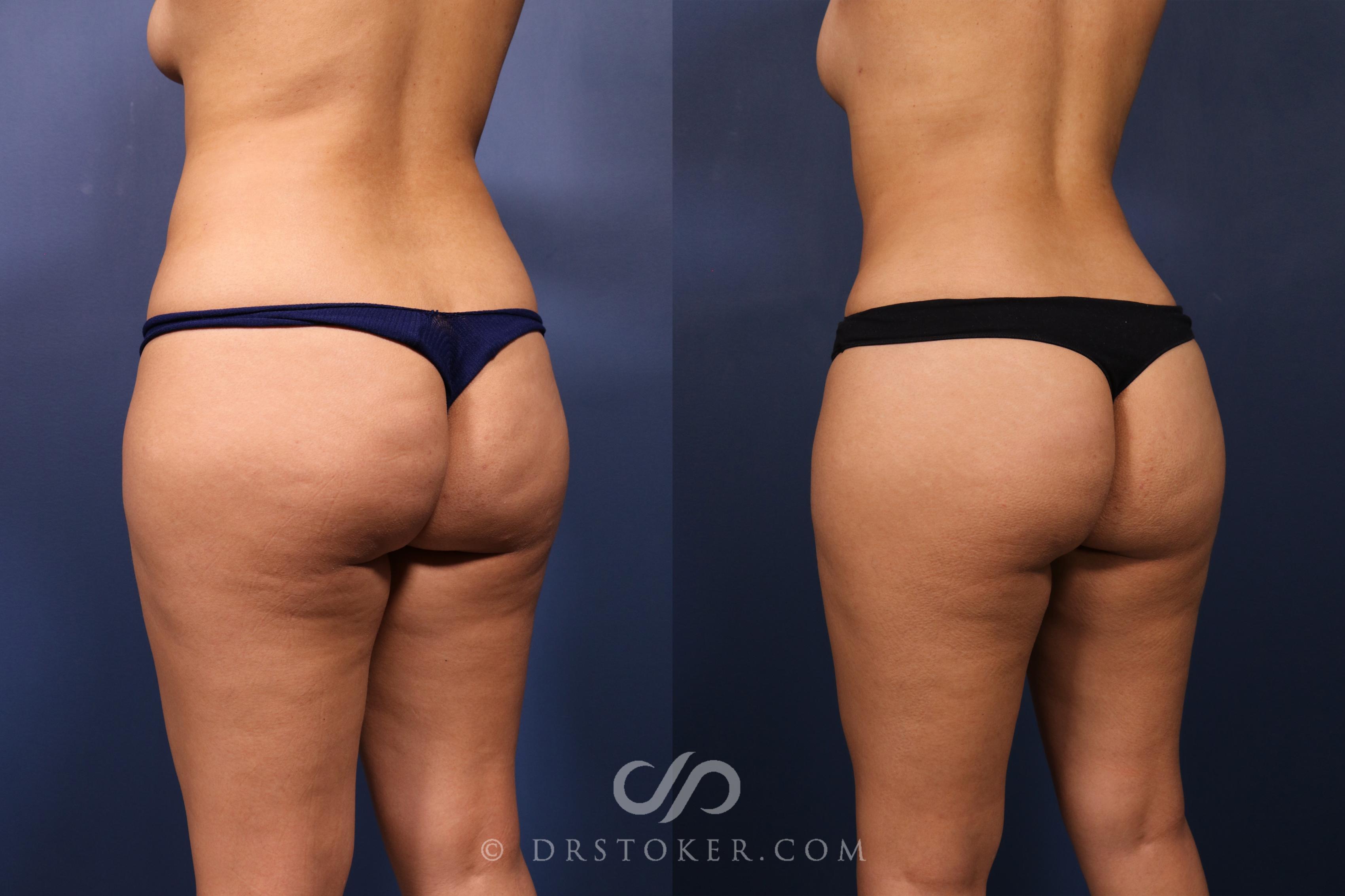 Before & After Liposuction Case 2489 Left Oblique View in Los Angeles, CA