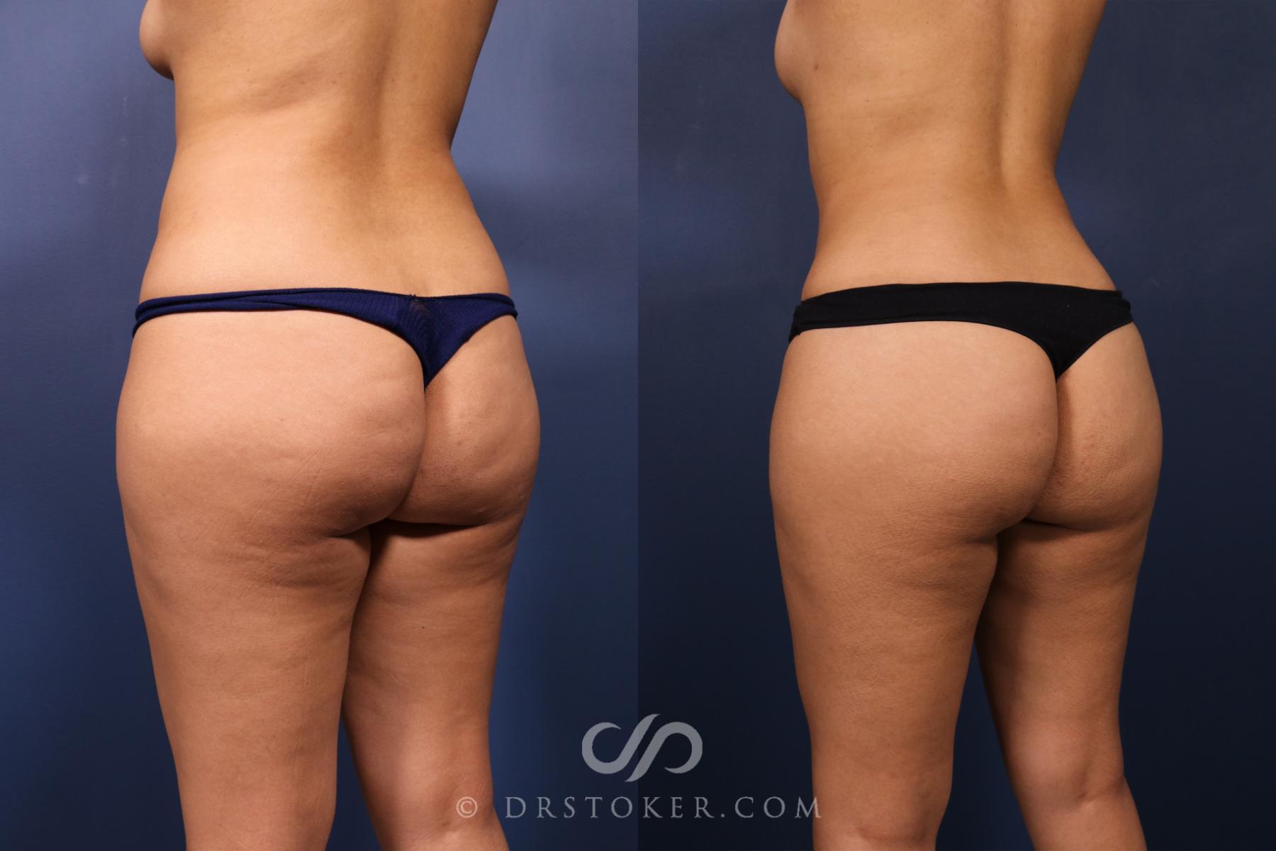 Before & After Liposuction Case 2489 Left Oblique View in Los Angeles, CA