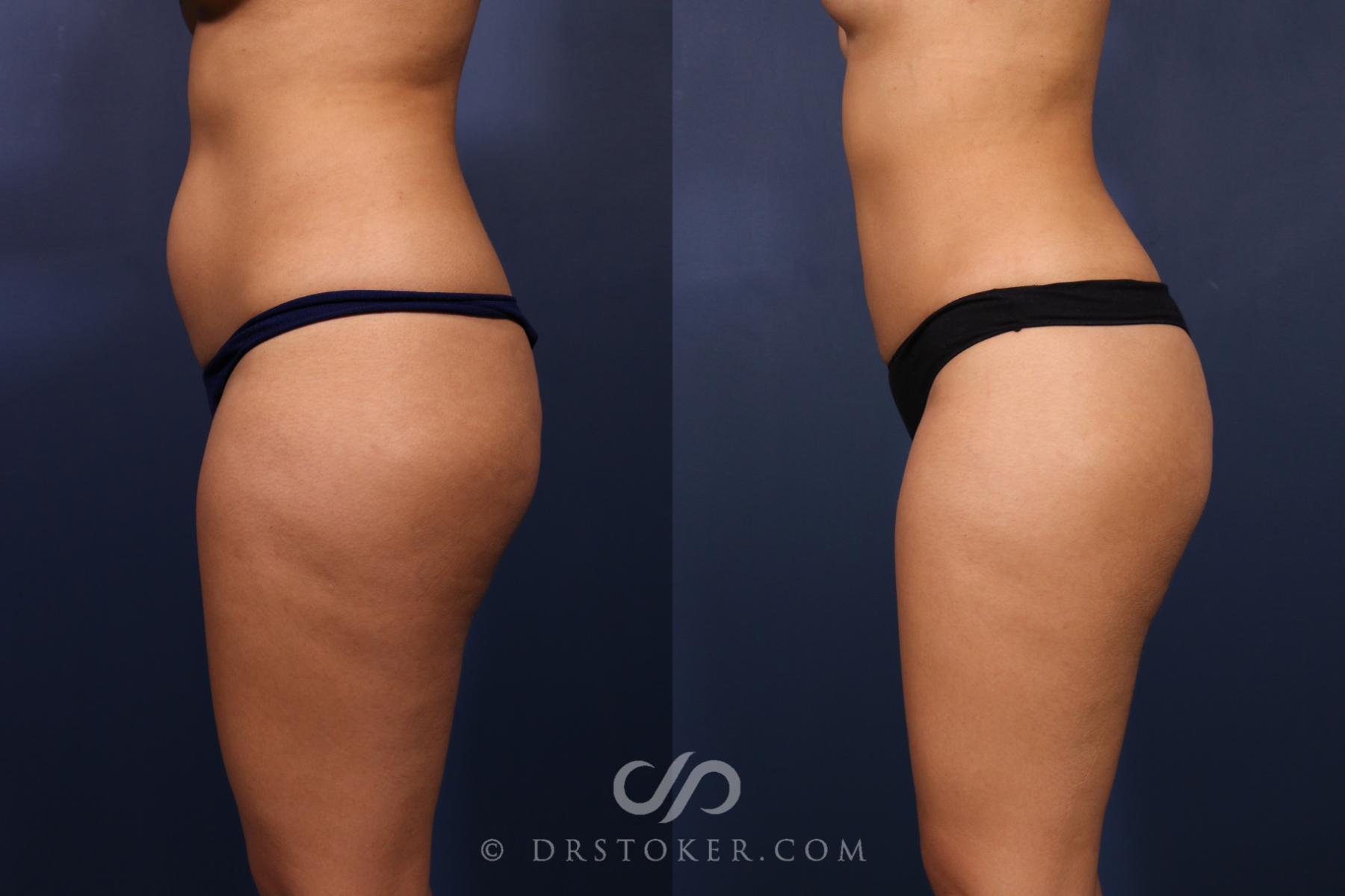 Before & After Liposuction Case 2489 Left Side View in Los Angeles, CA