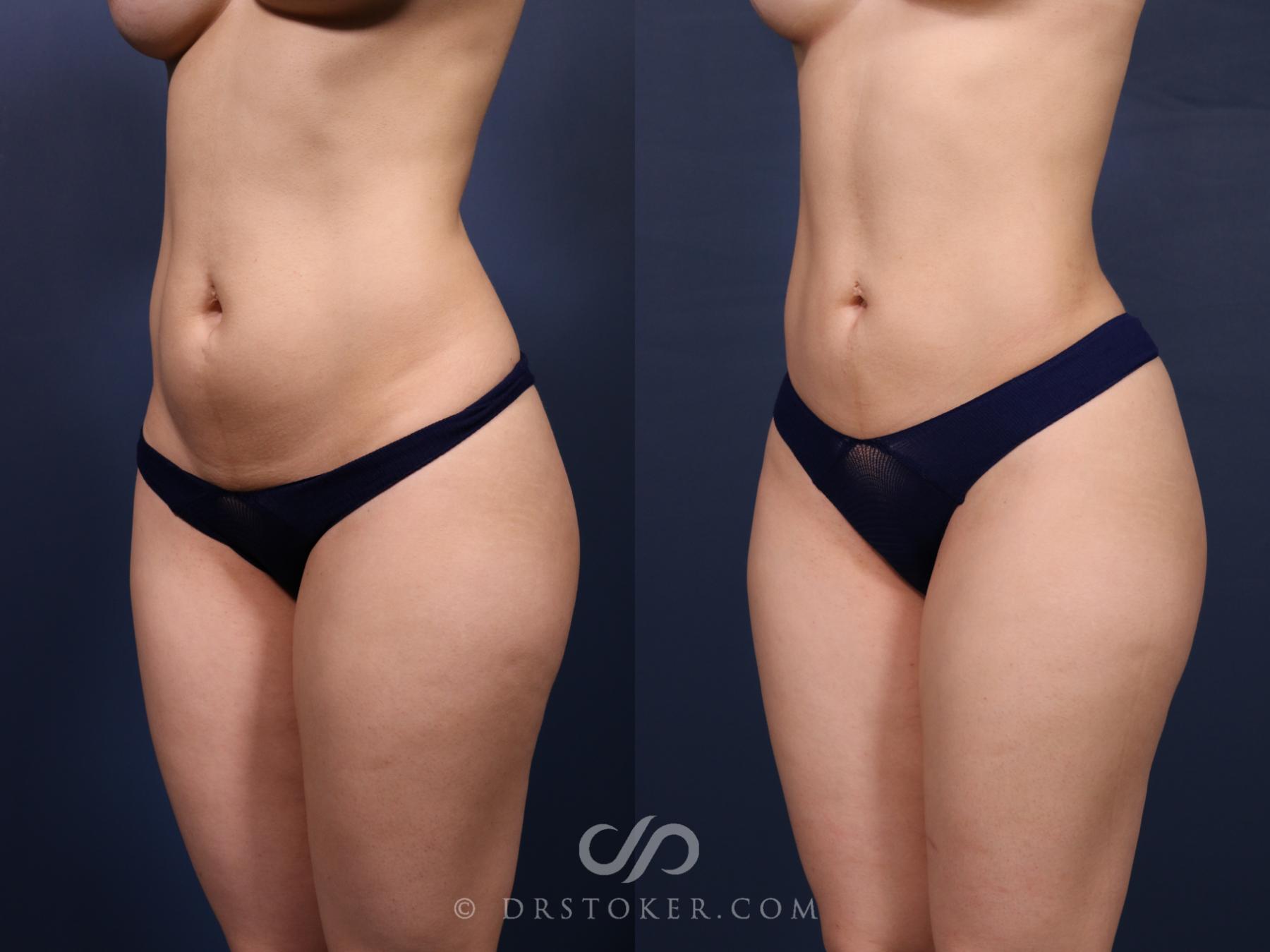 Before & After Liposuction Case 2575 Left Oblique View in Los Angeles, CA